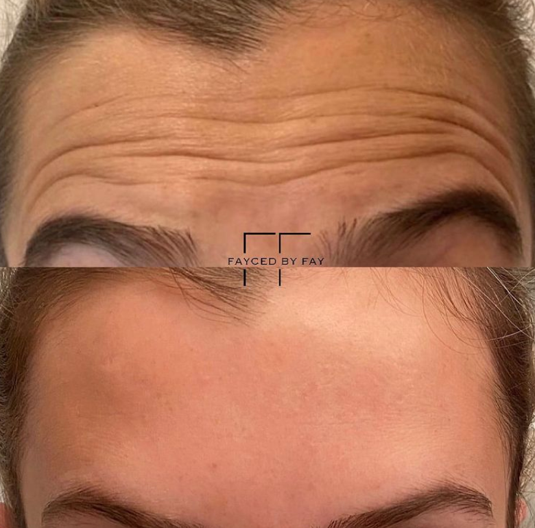 Forehead Botox