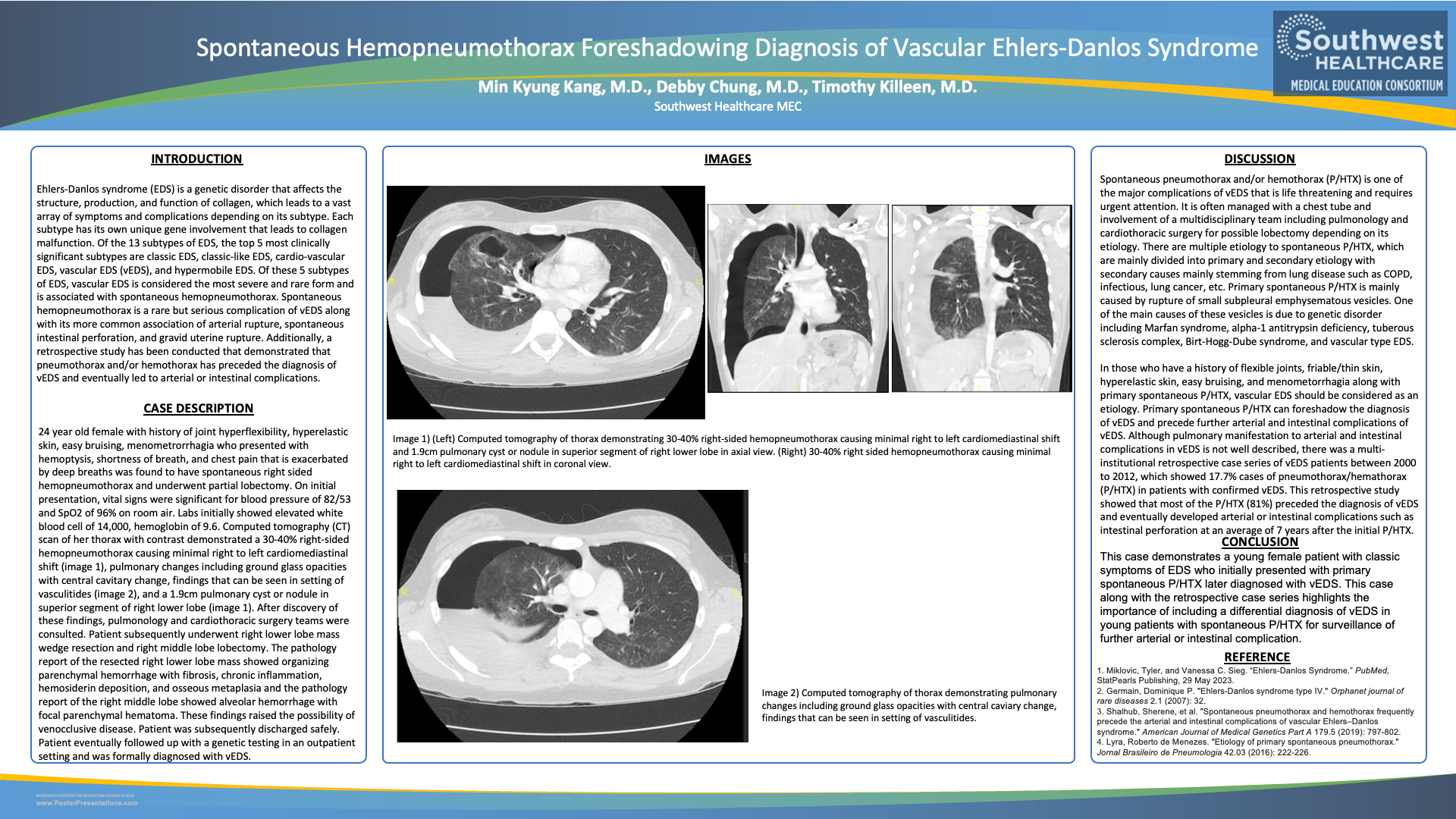 Spontaneous Hemopneumothorax Foreshadowing Diagnosis of Vascular Ehlers-Danlos Syndrome  .png
