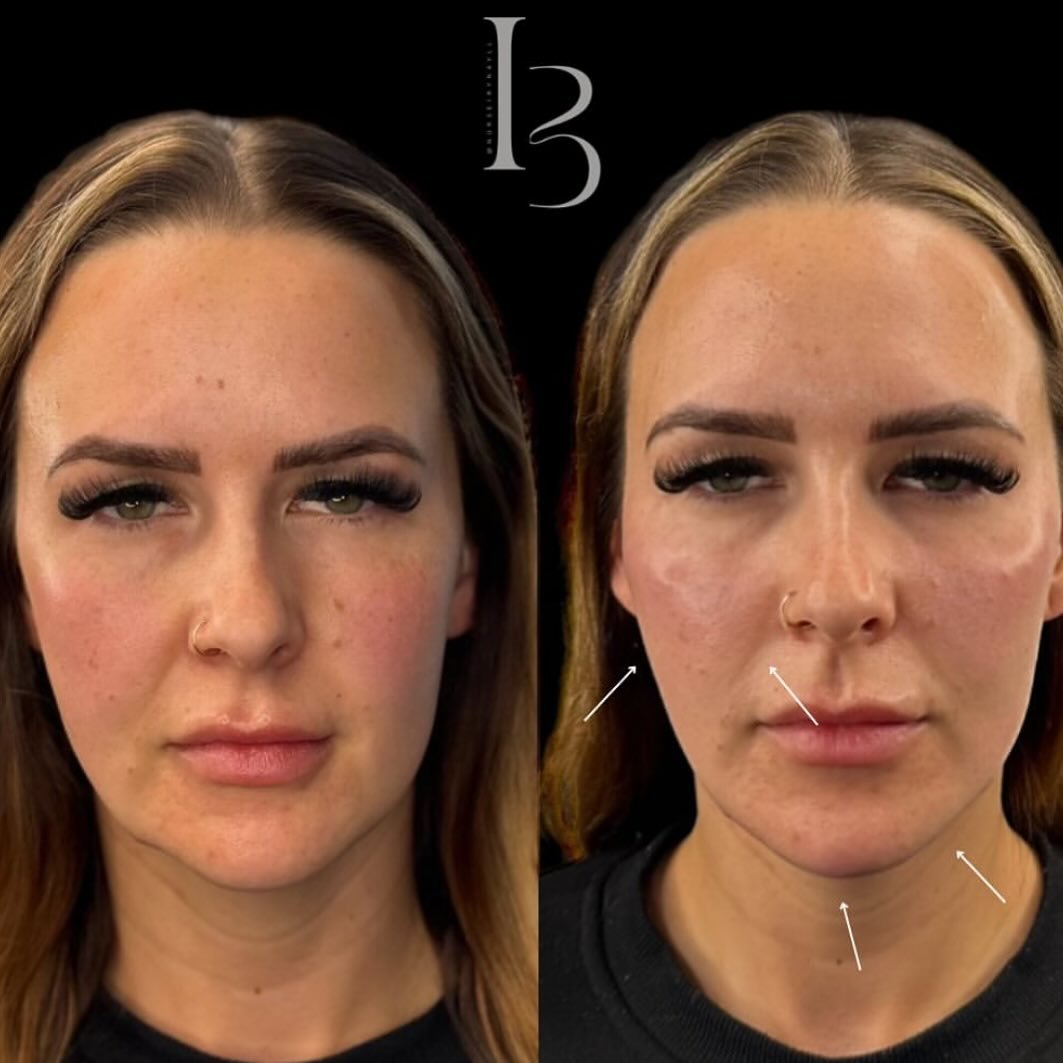 Cheeks, Jaw &amp; Chin! This is the before and after from the reel we posted yesterday - stunning 👏🏻🫧💉 

All treatments done by our Nurse Injector @nurseirynayll . Photos and videos posted with client consent. 

For any cosmetic injectable treatm