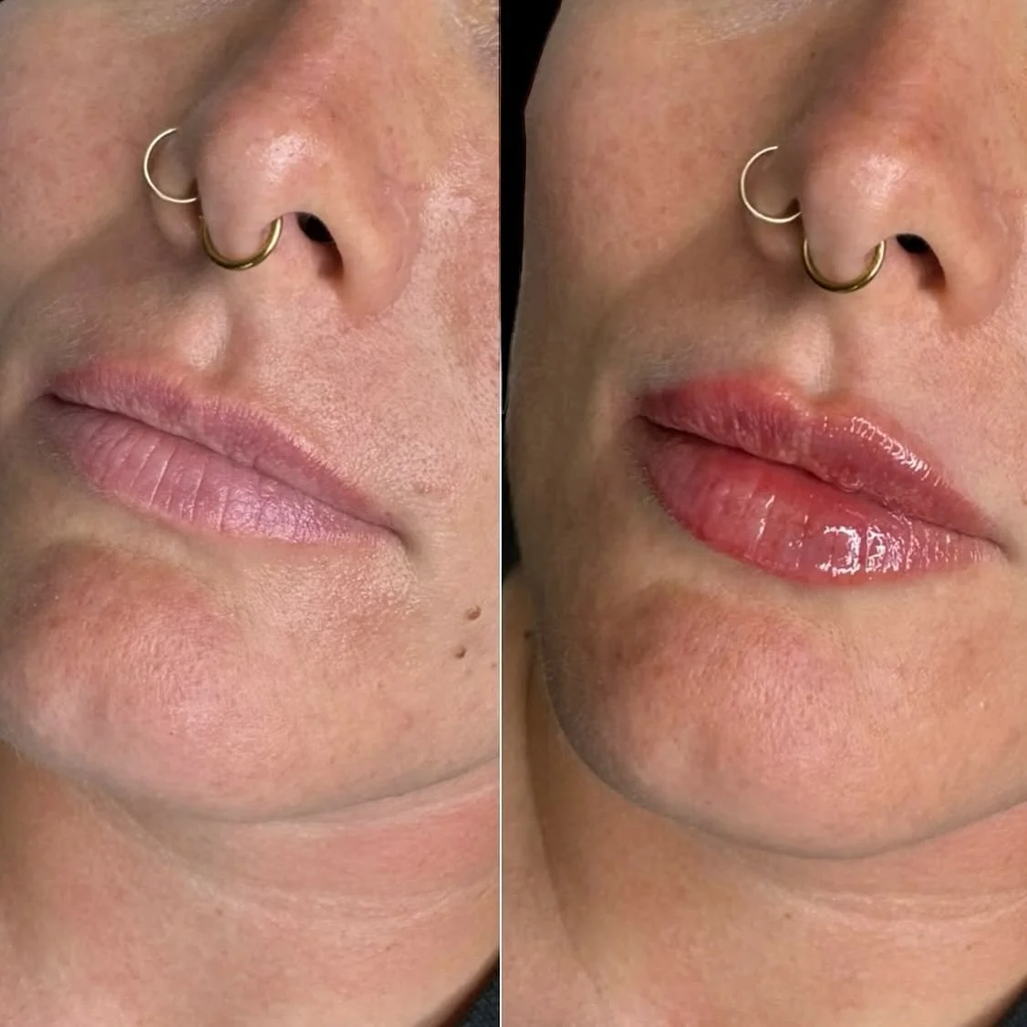 MWUAAAH! 😘💋 Would you believe us if we said these results were achieved with only 1/2 a syringe of filler?! @nurseirynayll is THAT GIRL. Strategic placement and a skilled Nurse Injector is the perfect recipe for gorgeous lips. 
Iryna has her Novem