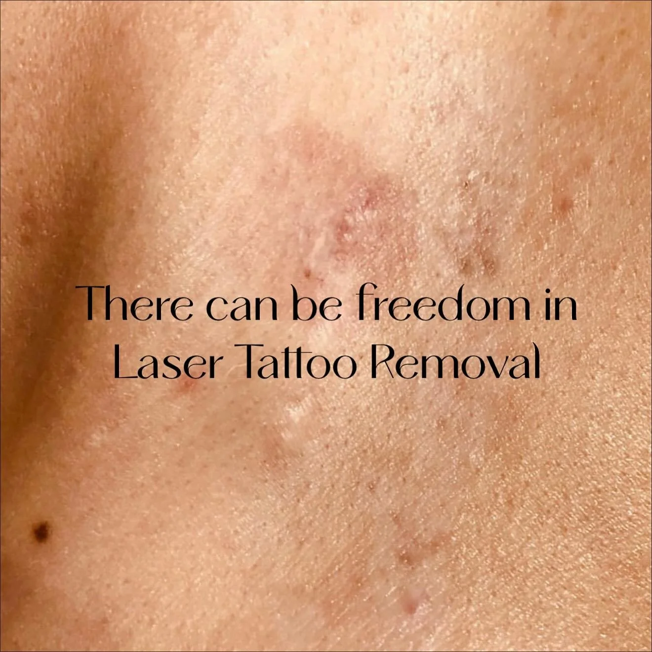 Swipe for a ‘before and after’ . For some people there is so much freedom and relief once a tattoo is gone. For some people tattoos hold grief or negative memories. This is your reminder (with so much love) that we are here to give you yo