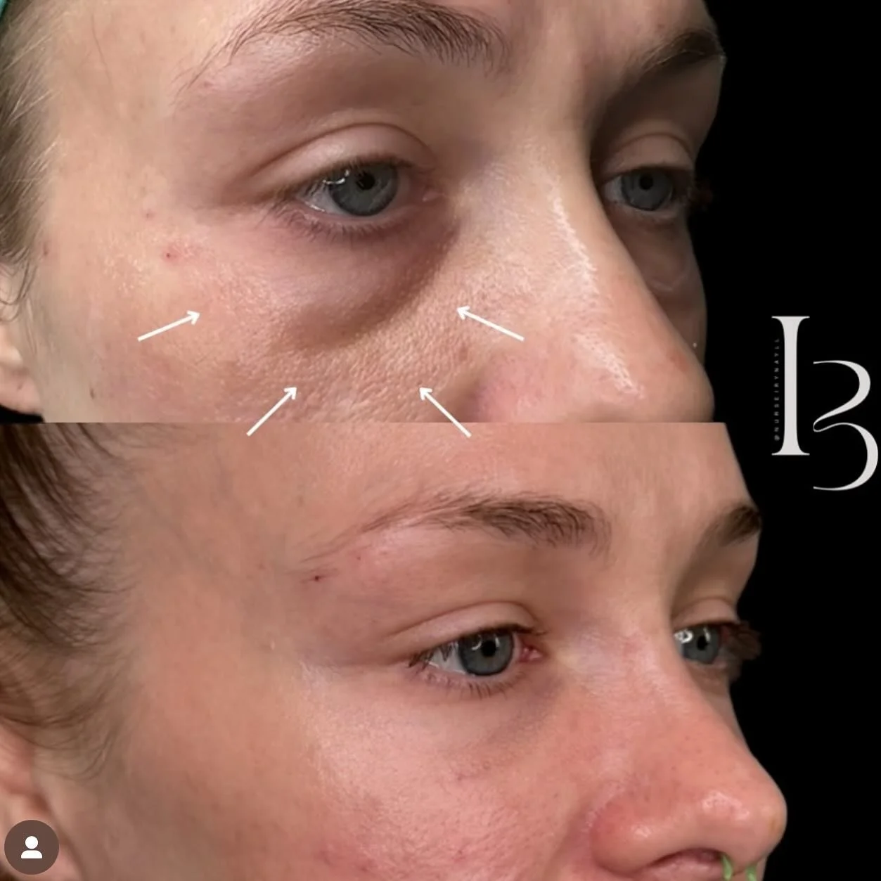 Incredible results with under eye filler by our Advanced Nurse Injector @nurseirynayll 💉 Iryna&rsquo;s December schedule is open now! Call or DM the clinic to find out more. Online booking unavailable for injectable treatments. 

All new Nouveau inj