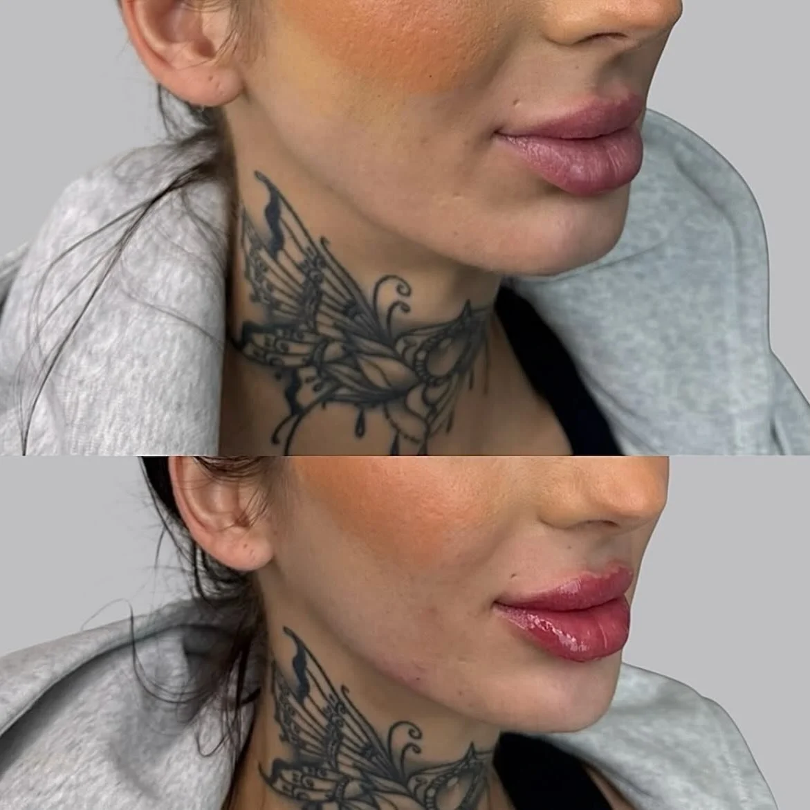 A little lower face balance created by @nurseirynayll 💉 She is currently booking into March and spots are going fast. Don&rsquo;t miss out, call or DM to secure an appointment with our amazing Advanced Nurse Injector. 

#cosmeticinjectableslloydmins