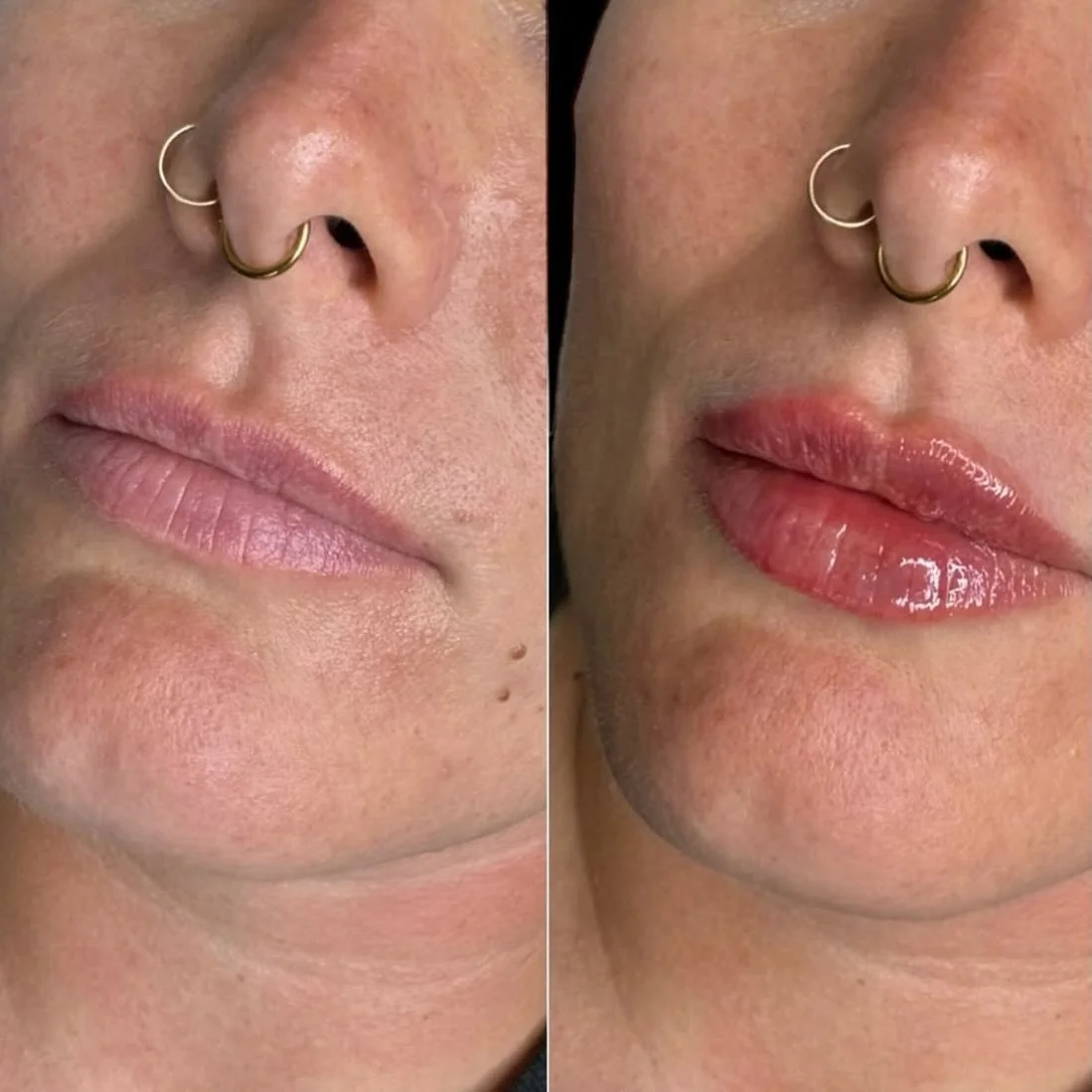 ATTN ✨👏🏼 @nurseirynayll has ONE last minute appointment available for Dermal Filler this Saturday at 12:00pm! Iryna&rsquo;s schedule fills up incredibly fast, and this spot won&rsquo;t last long. DM or Call the clinic to book in. 

This spot is ava