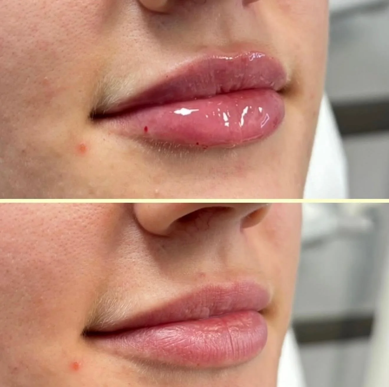 Miss her? Us too! @pokedbychey is back in the clinic starting April 18th. Her dates are limited, and she books up fast! So make sure to call or DM the clinic to secure your appointment. 

#cosmeticinjectionslloydminster #youglowgirl #discoverlloydmin