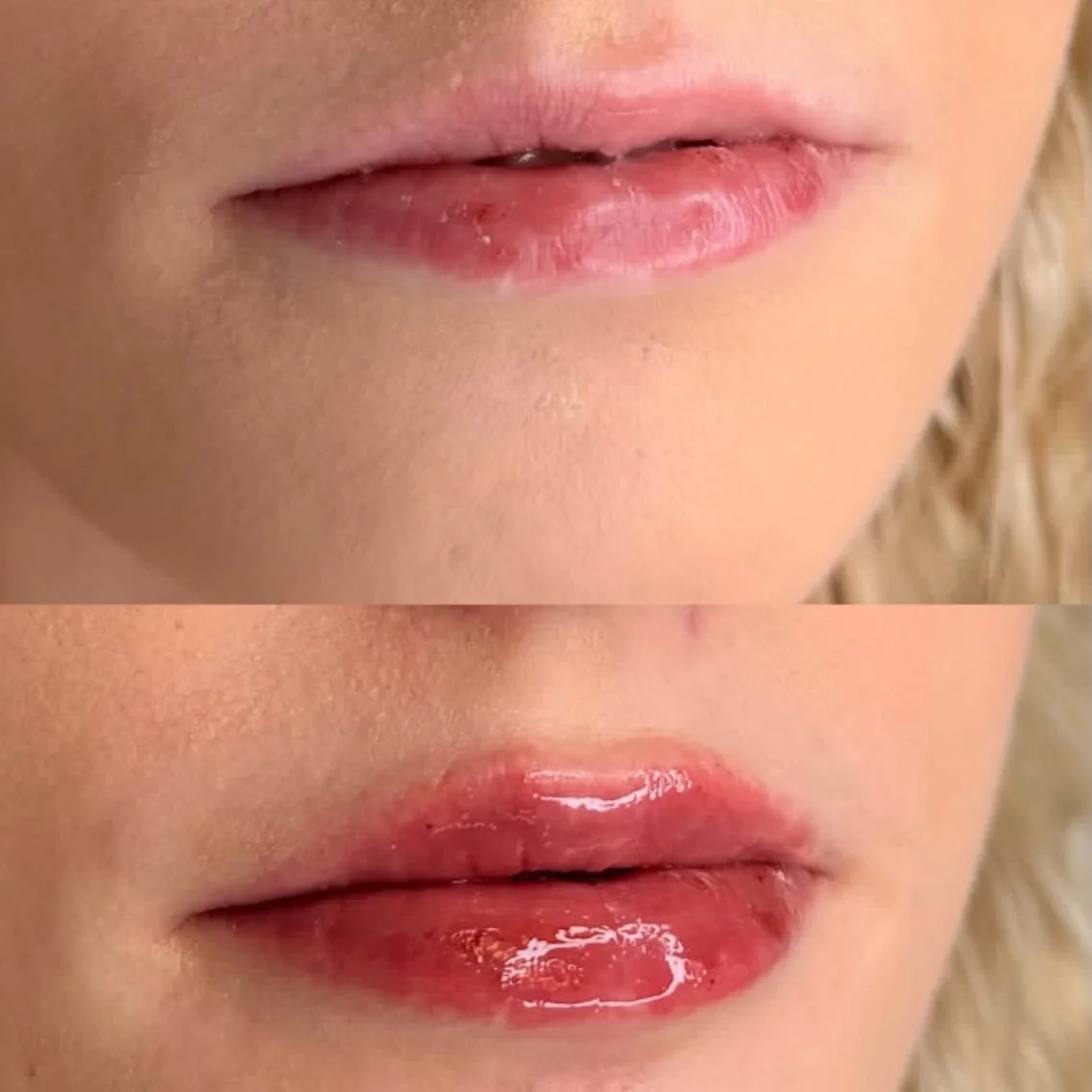 Would you believe us if we said @nurseirynayll only used 1/2 a syringe to create such beautifully shaped lips? It&rsquo;s the truth! 💓 She&rsquo;s just THAT good! Hydration and a little plump? Yes please!! 

#lipfillerlloydminster #discoverlloydmins