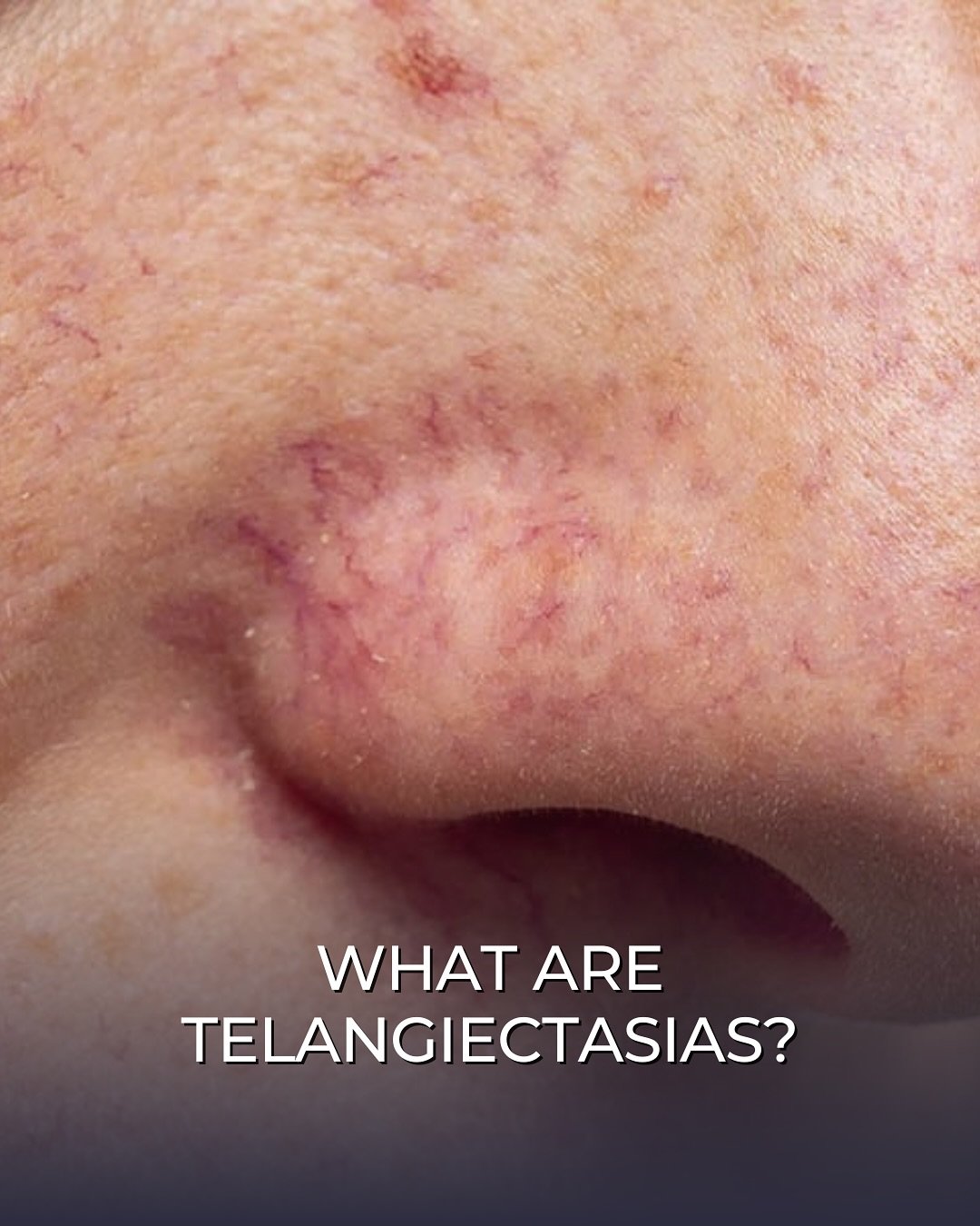 Tiny Red Veins? Here&rsquo;s What You Need to Know

Telangiectasia, also known as spider veins or broken capillaries, are small, visible blood vessels that appear on the face and body. They&rsquo;re harmless but can be a cosmetic concern.

✨ What Cau