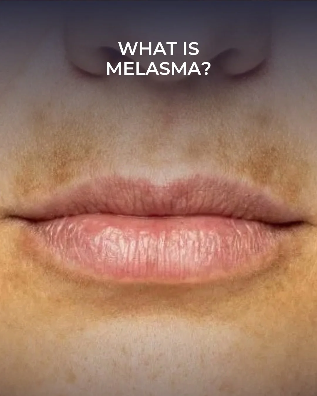 Melasma is hormonal pigmentation that shows up as brown or gray-brown patches, most commonly on the cheeks, forehead, upper lip, and jawline.

Melasma can be treated but it needs a delicate approach. Treatments we use include:
- PicoSure laser
- Medi