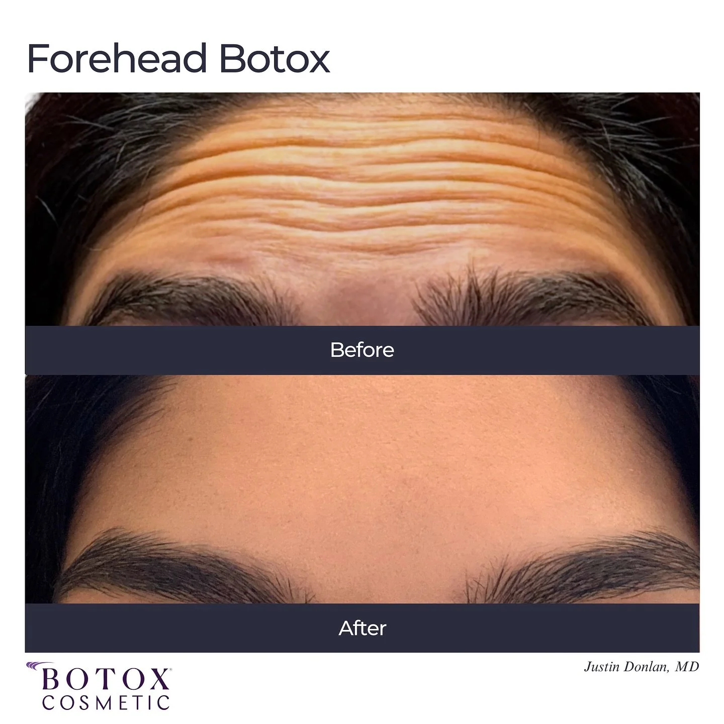 Before and After Forehead Botox ✔️

#botox #wrinkles #beforeafter #foreheadwrinkles