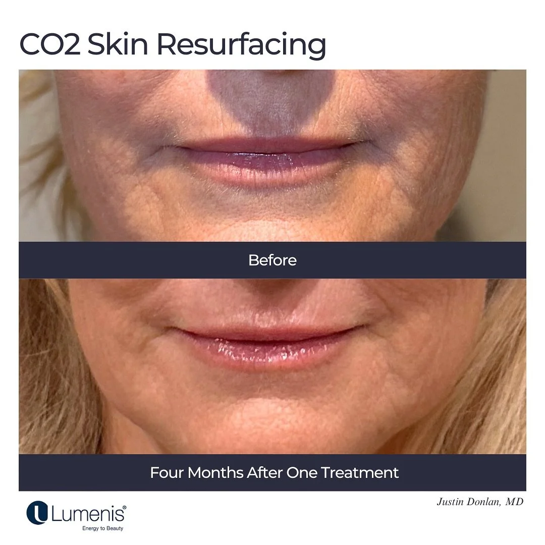 Before &amp; After CO₂ Laser Resurfacing
Four months after treatment, this patient has smoother skin and a noticeable reduction in fine lines and wrinkles around her mouth, chin, and neck.
CO₂ laser resurfacing works beneath the surface to stimulate 