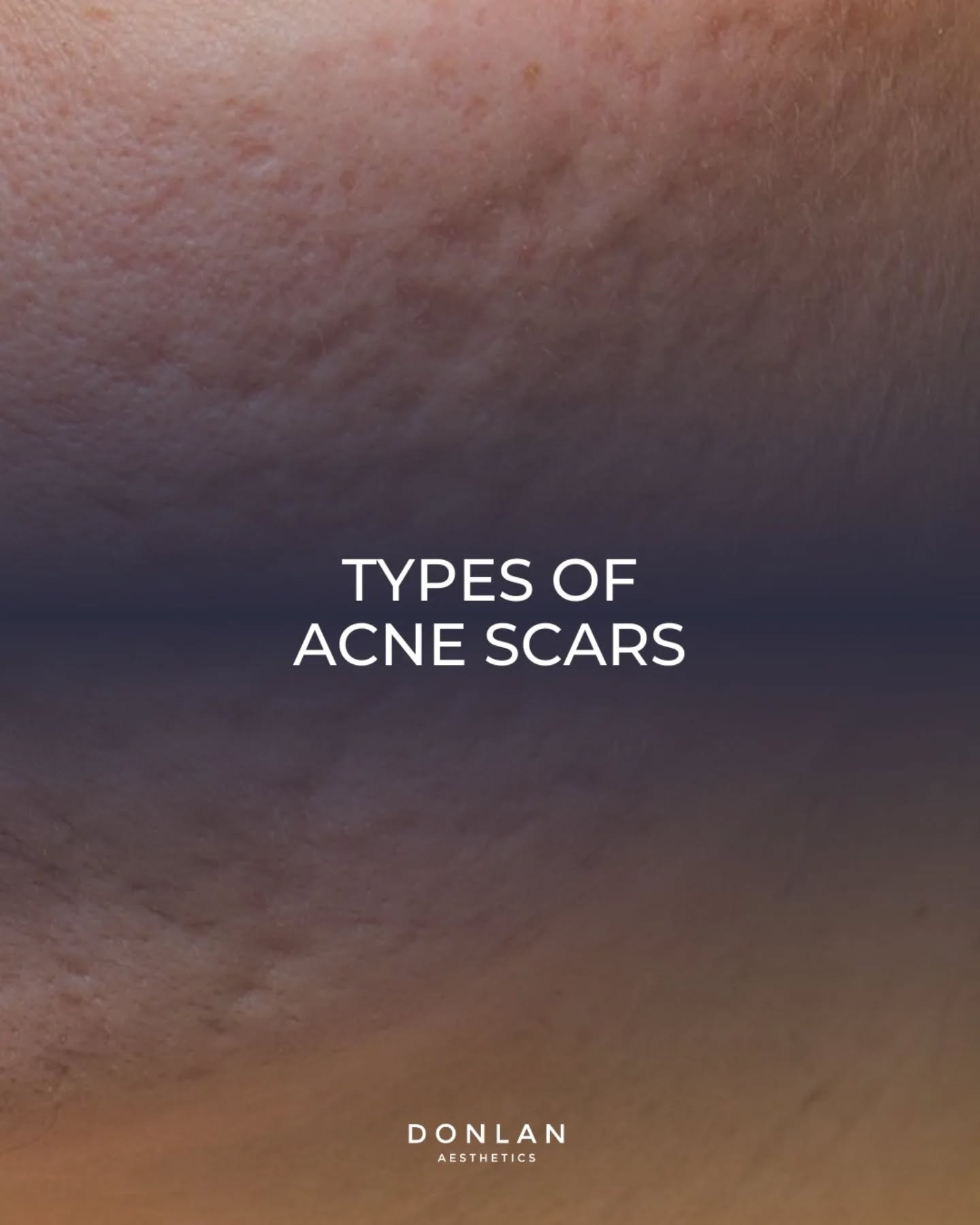Acne scars are a common result of inflammation caused by breakouts that damage the skin&rsquo;s collagen. The most common types include ice pick, boxcar, and rolling scars&mdash;each with a different shape, depth, and cause. Because no two scars are 