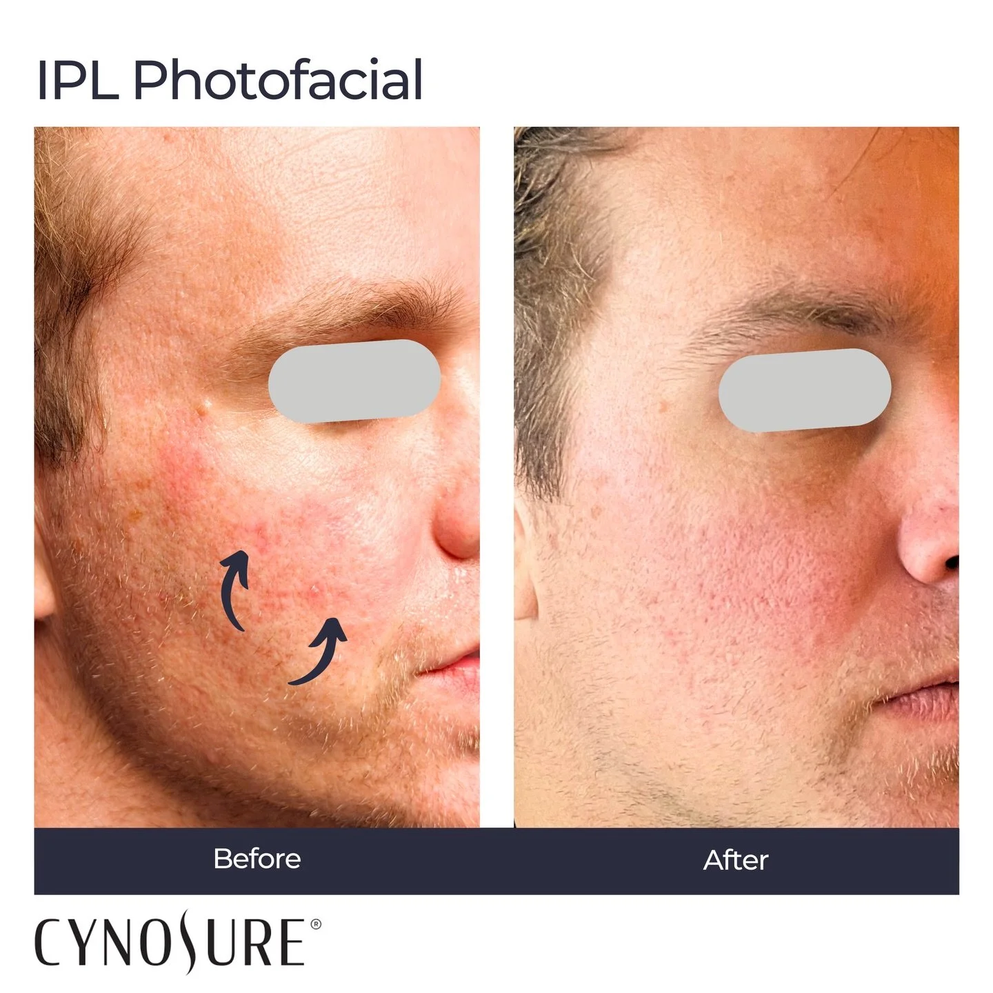Before and after IPL targeting broken capillaries and telangiectasia.

#ipl #telangiectasias #brokencapillaries #iplphotofacial 
#beforeandafter