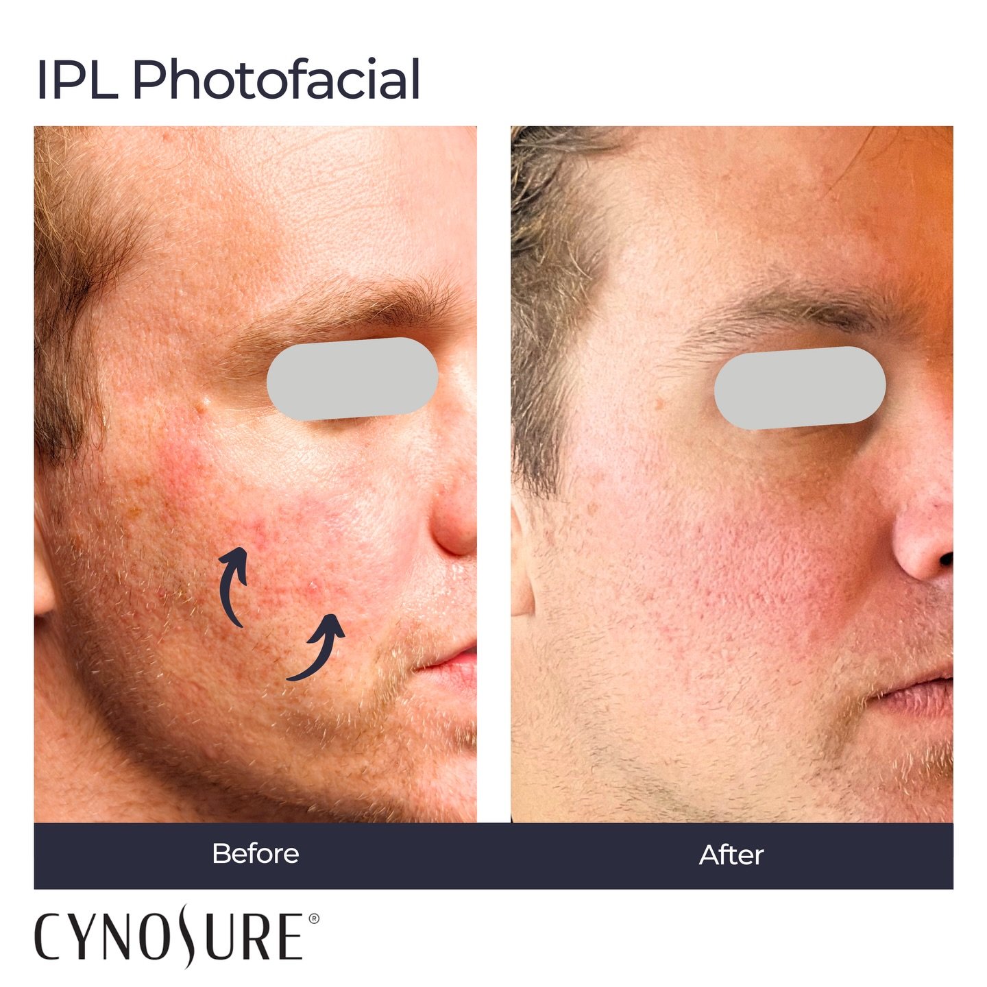 Before and after IPL targeting broken capillaries and telangiectasia.

#ipl #telangiectasias #brokencapillaries #iplphotofacial 
#beforeandafter
