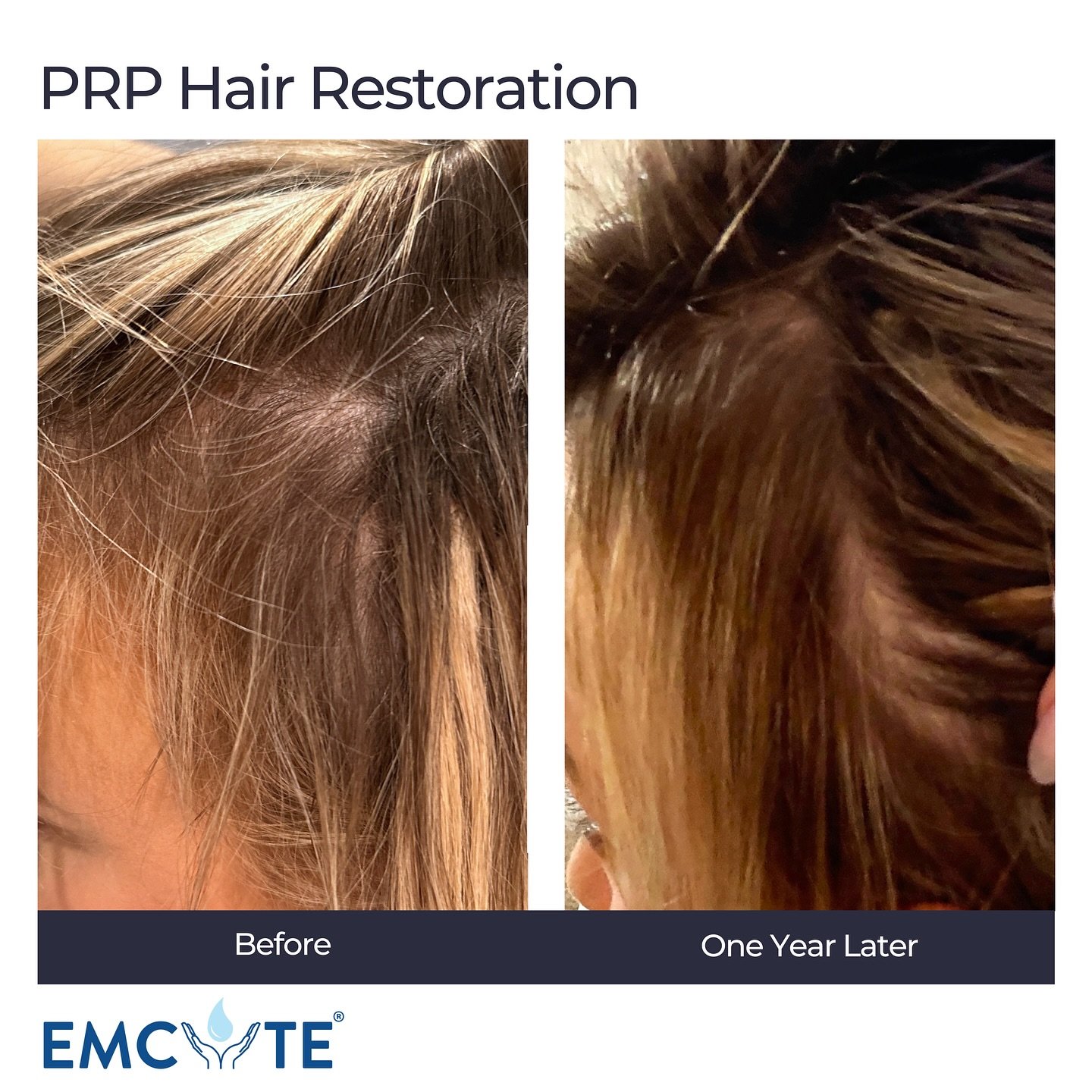 Before After PRP Hair Restoration
This patient had a series of three prp hair treatments targeting the front and middle of the scalp. After a year the full results can be seen, thicker hair with new growth as well. 

#prp #prphair #prphairrestoration