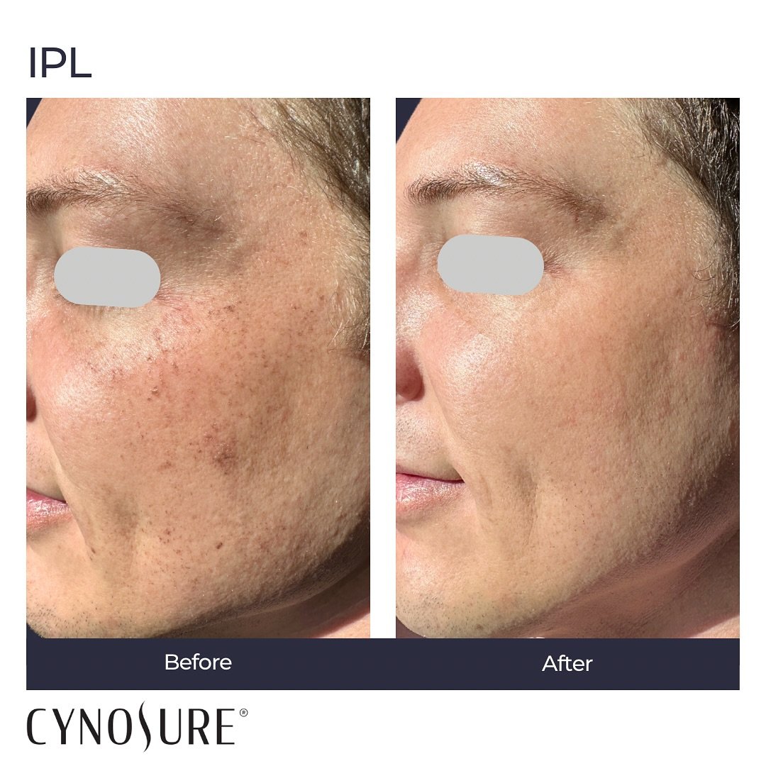 Before and After IPL Targeting Sun Damage
IPL is a tried and true treatment for lifting hyperpigmentation and sun spots. The treatment is often combined with peels and a tailored skincare regimen.

#ipl #iplphotofacial #beforeandafter 
#sunspots