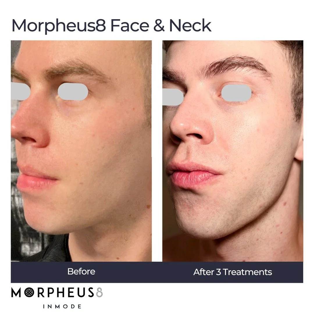 Before and After a Series of Three Morpheus8 Treatments
This patient had significant volume loss under the eyes and skin laxity concerns. After a series of treatments there was significant volume restored, overall skin texture smoother, and tightenin