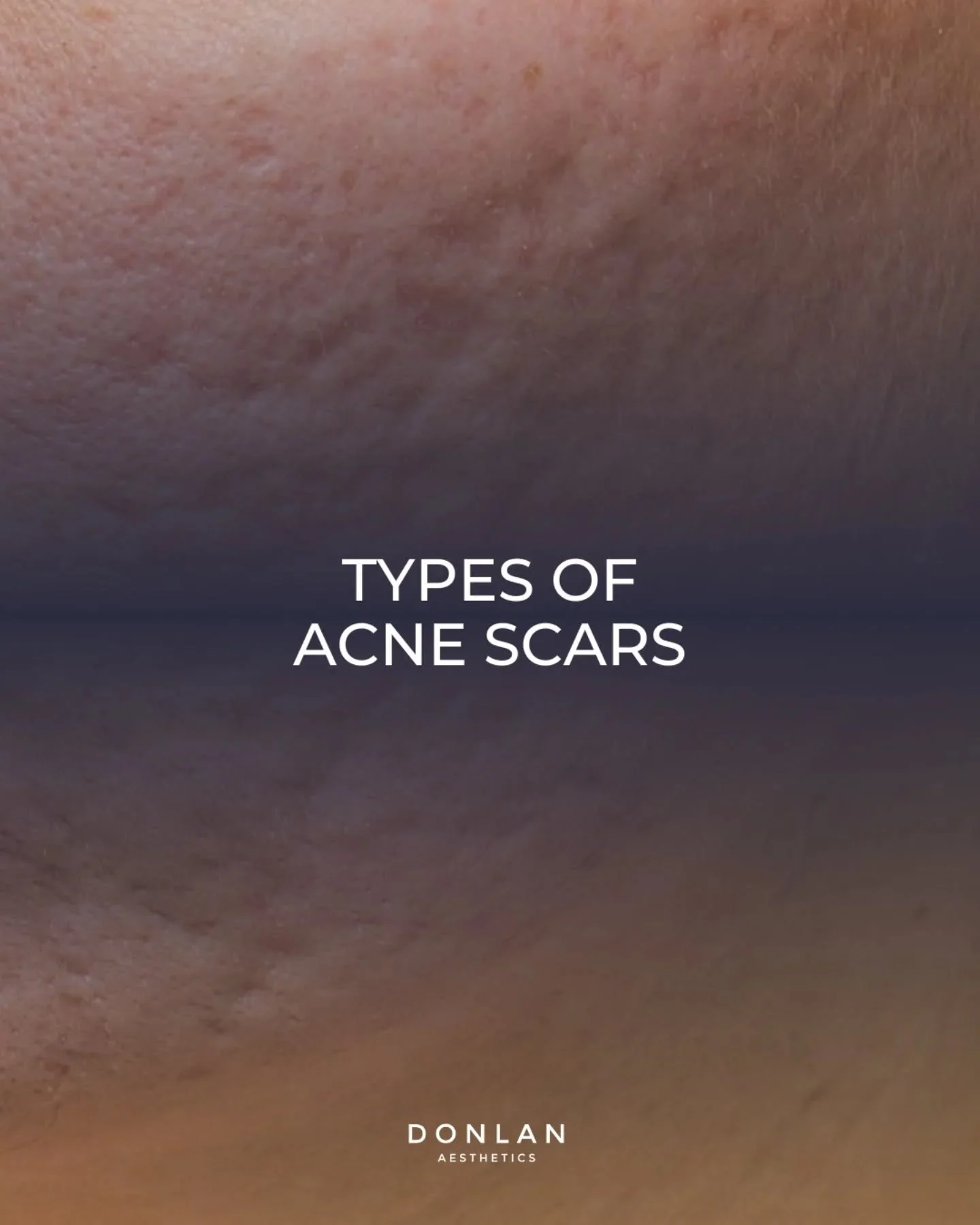 Acne scars are a common result of inflammation caused by breakouts that damage the skin&rsquo;s collagen. The most common types include ice pick, boxcar, and rolling scars&mdash;each with a different shape, depth, and cause. Because no two scars are 