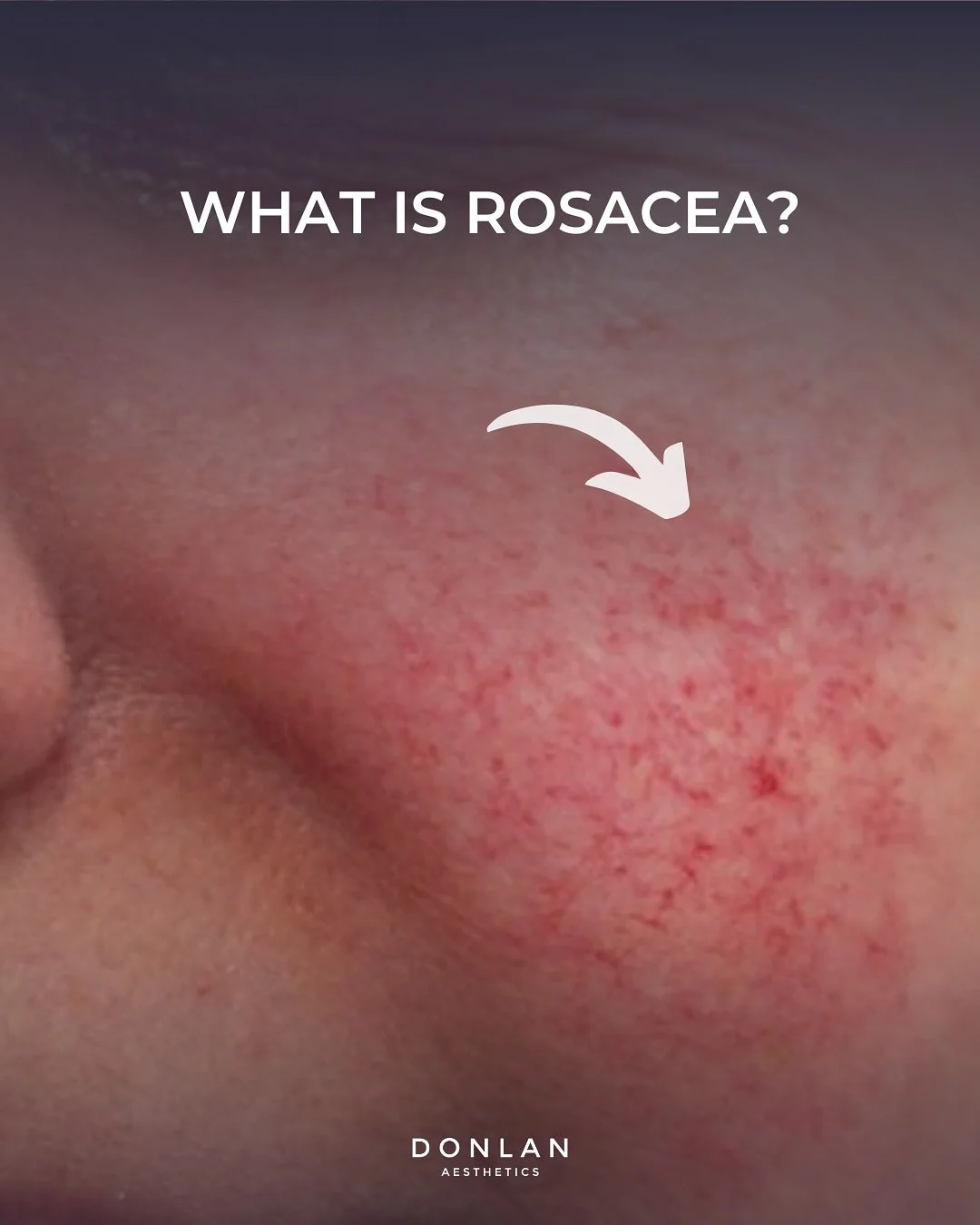 Rosacea is a chronic skin condition that causes persistent redness, visible blood vessels, and sensitivity. It often shows up as flushing, bumps, or diffuse redness across the cheeks, nose, and forehead. Triggers like heat, alcohol, stress, sun expos