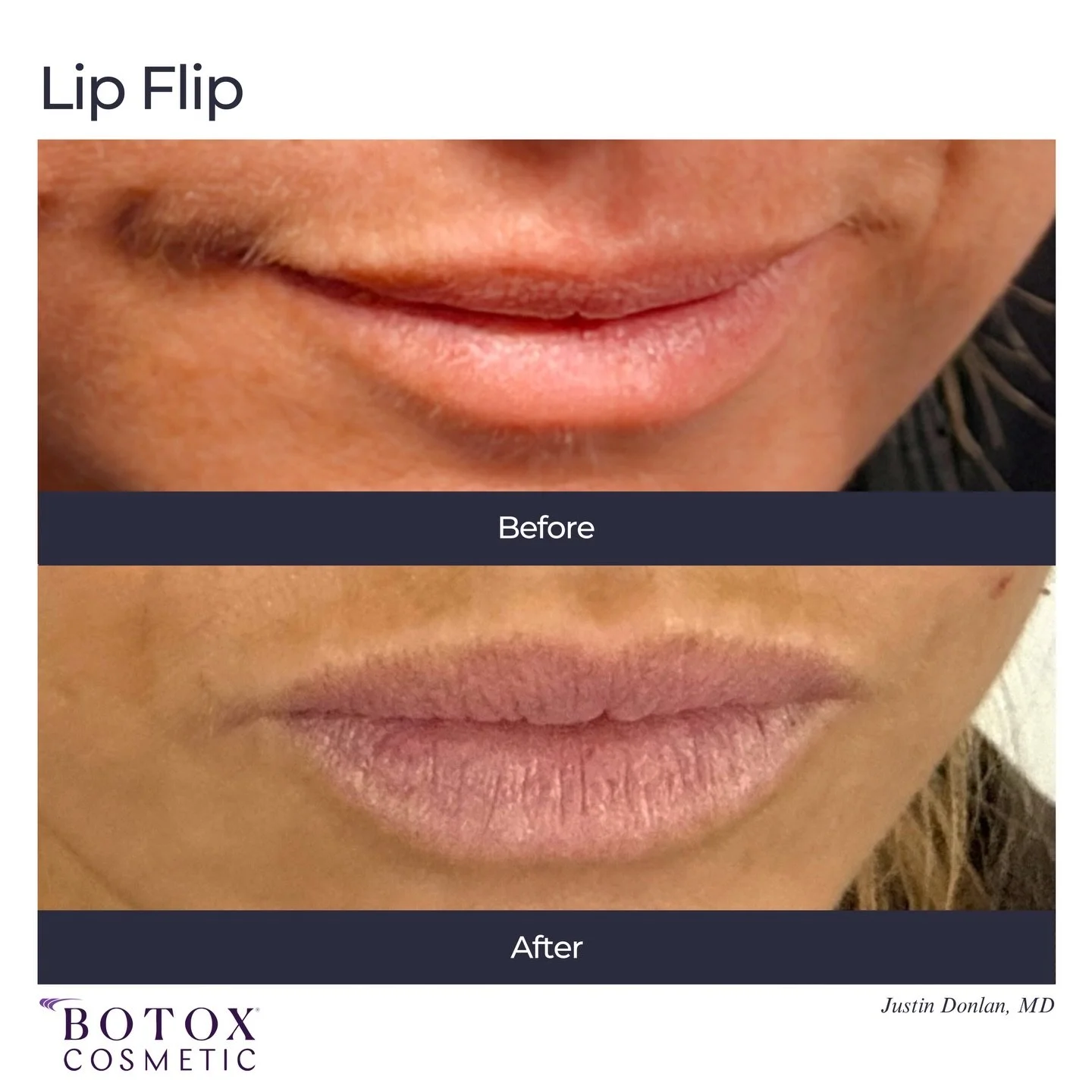 Before and After Botox Lip Flip
Less than 10 units of Botox required to achieve this result along the top lip. Numbing is required.

#botox #lipflip #lips #lip
