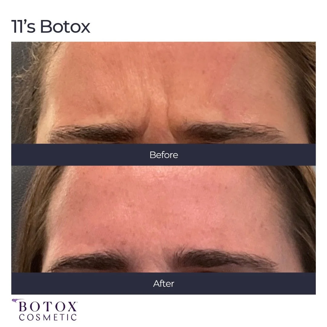 Botox Before and After
The 11&rsquo;s refer to the two lines that form over time between the eyebrows and are one of the most popular areas to treat with Botox. This patient not only was able to freeze the lines, but also saw them come back less pron