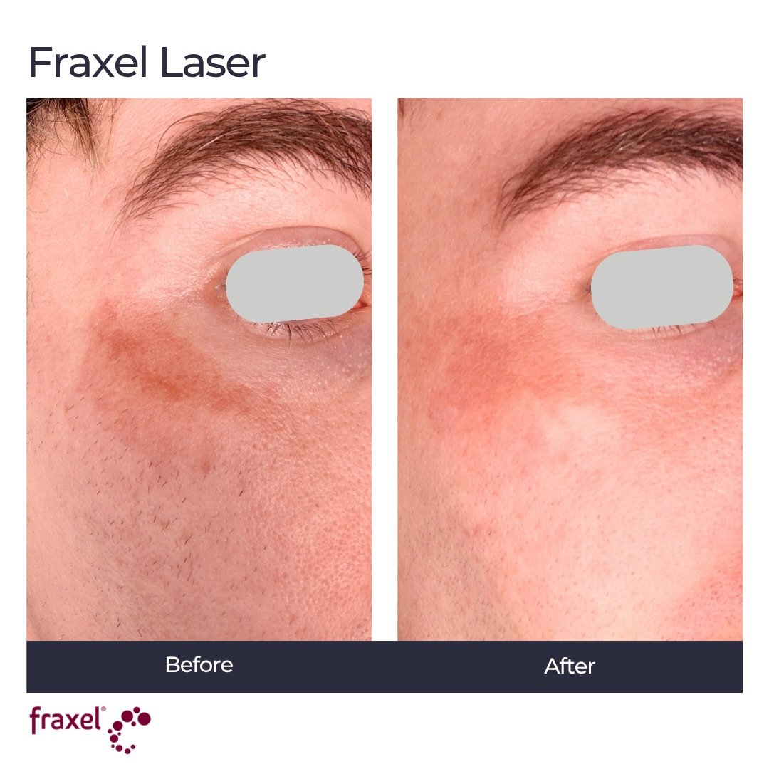 Before and after: Fraxel for sun damage and pigment.

This patient wanted to address years of sun exposure and uneven tone. We used the Fraxel Dual 1927 nm wavelength, which targets pigment near the skin&rsquo;s surface and helps break up sun spots a