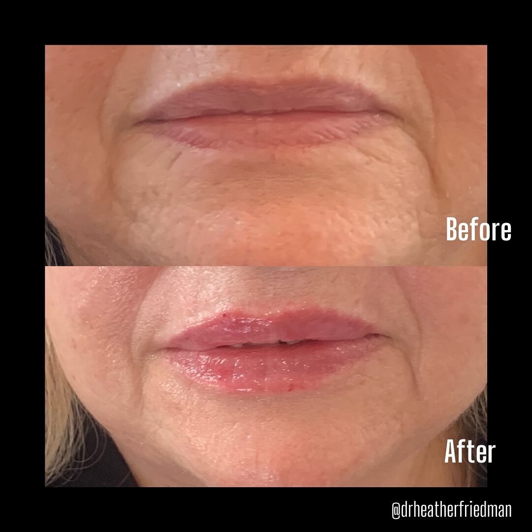 A lil lip filler with juvederm volbella ❤️

#portlandjuvederm #oregonlipfiller #portlandlipfiller #portlandvolbella #pdxjuvederm #portlandlipenhancement #pdxvolbella #portlandlipinjection #oregoncosmeticfillers #portlandliptransformation #pdxlipfille