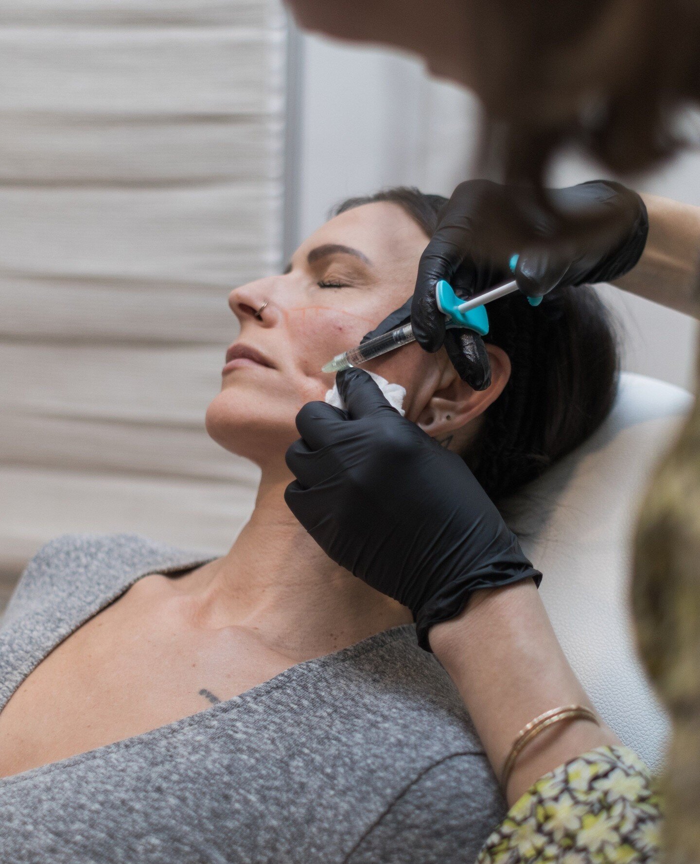 What to expect at a SKINVIVE appointment: ⁠
⁠
The appointment itself takes about 30 minutes. ⁠
⁠
We begin with numbing the area of treatment for about 20 minutes.  After we cleanse the skin, we begin injecting the treatment area.  We use a small need