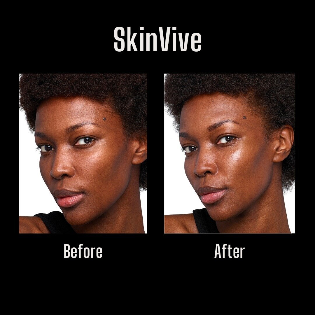 Common Questions for SkinVive: ⁠
⁠
Can SkinVive be dissolved? Yes, SkinVive is a hyaluronic acid-based product that can be dissolved with hyaluronidase.⁠
⁠
How Does SkinVive Work?⁠
⁠
SkinVive improves skin quality and skin hydration by increasing AQP