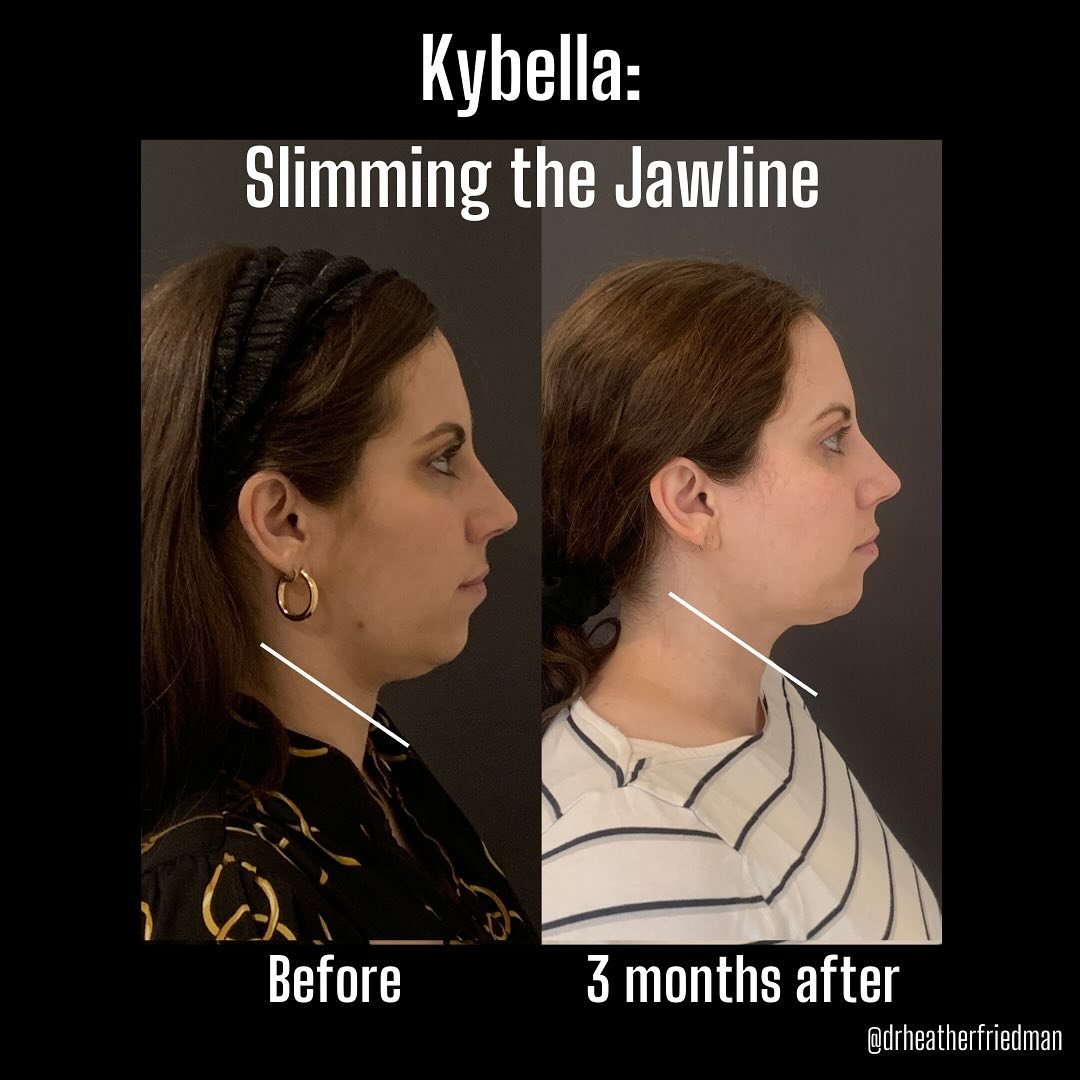 #kybellabeforeafter ❤️ we are loving these long awaiting #kybella results.  Kybella is a fat-destroying acid that is FDA approved to address the &lsquo;double chin.&rsquo; There is nothing immediate about these results and be ready for some downtime!