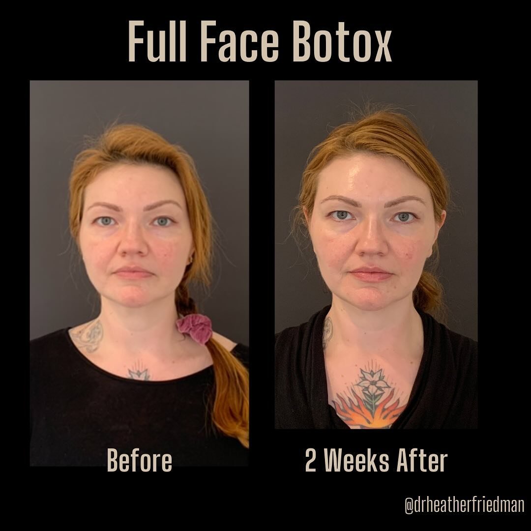 For those of us looking for a lil enhancement, or for something to help make us look rested, consider Botox. 

Botox is an &lsquo;opposite medicine,&rsquo; so when injected into a particular muscle, the outcome will be opposite to the muscle&rsquo;s 