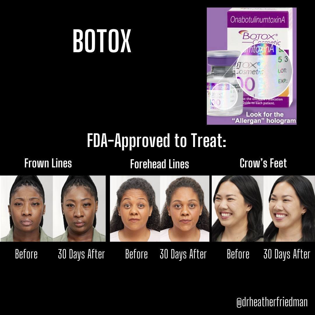To piggy-back off yesterday's post, a real Botox bottle can be authenticated by checking to see if there is a hologram on the bottle. ⁠
⁠
Also to note the areas where Botox is approved to treat.  In most cases, best results truly are when we treat th