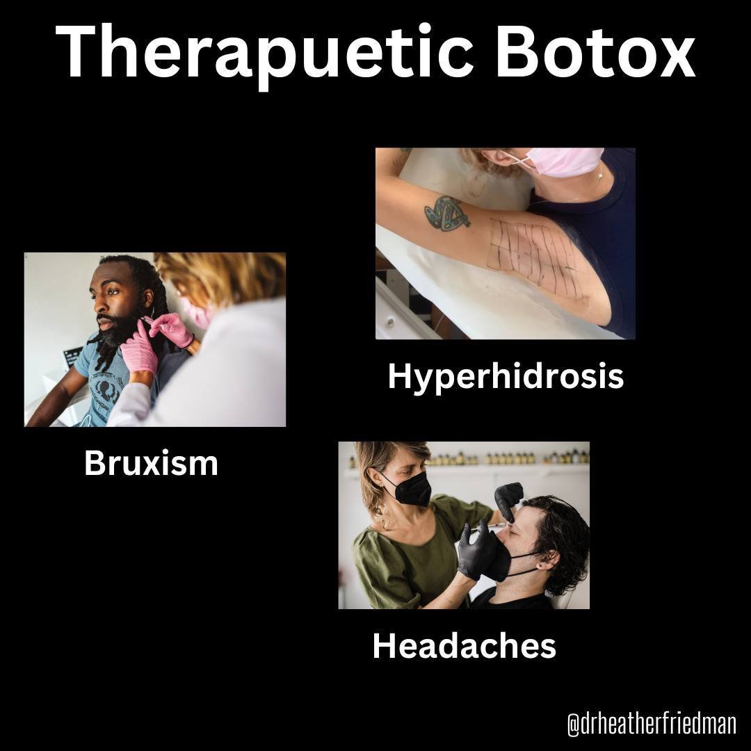 As much as we love Botox for an aesthetic outcome, we love it even more when it can help relieve unwanted symptoms.  In the right candidate, relaxing the masseter muscles can help with clenching, injecting superficially in the under arm area can redu