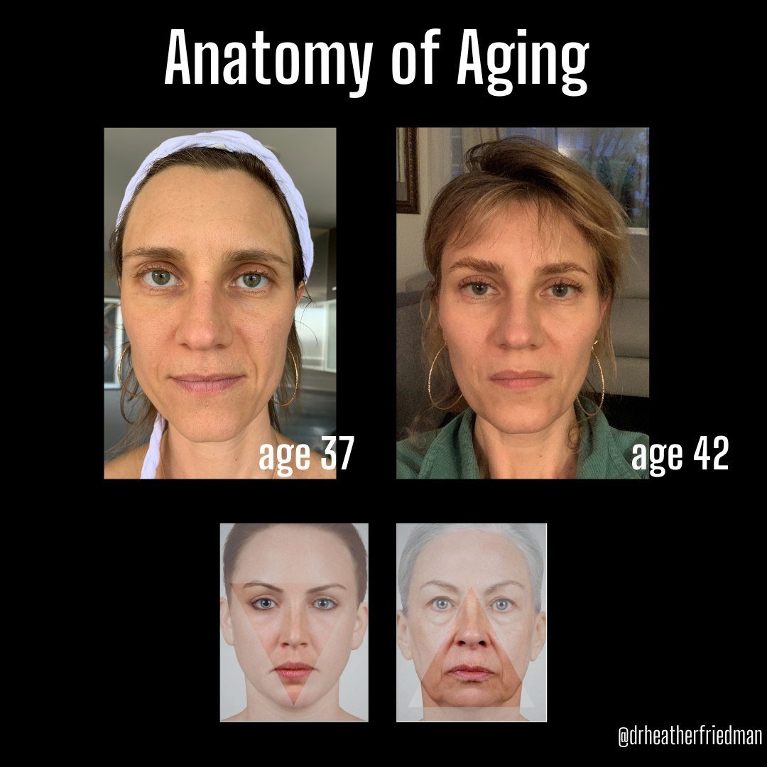 Anatomy of aging is a hot topic in my practice.  When we consider what is happening at the different layers of the face, I believe we set ourselves up for impactful and natural outcomes.  This inverted triangle phenomenon becomes apparent as we get i