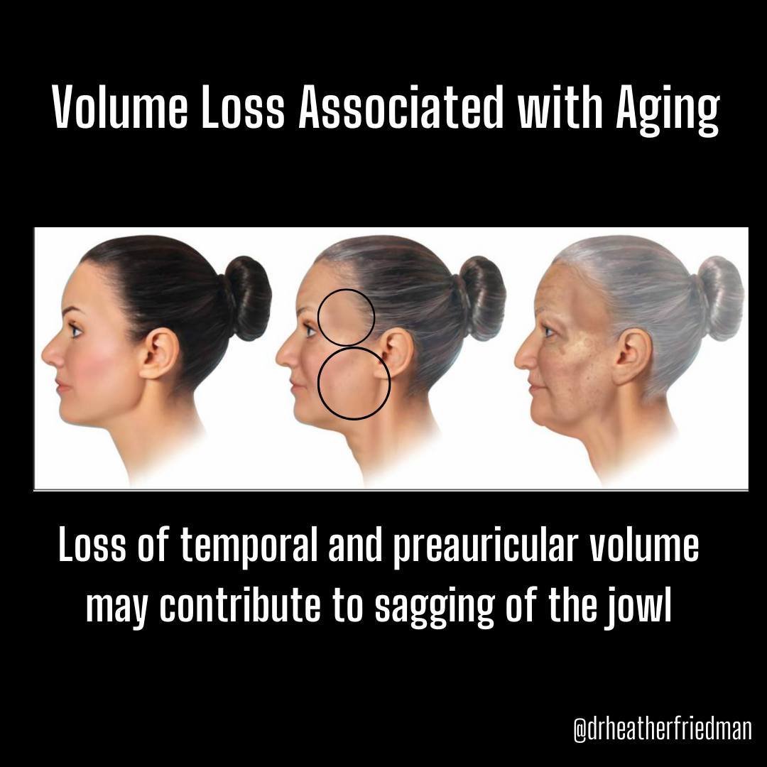 When we're young, our faces our full with volume.  Bones are at their thickest and the deep and superficial fat pads are voluminous.  With age comes volume loss, particularly lateral to the 'line of ligaments' in the temporal and preauricular (just b