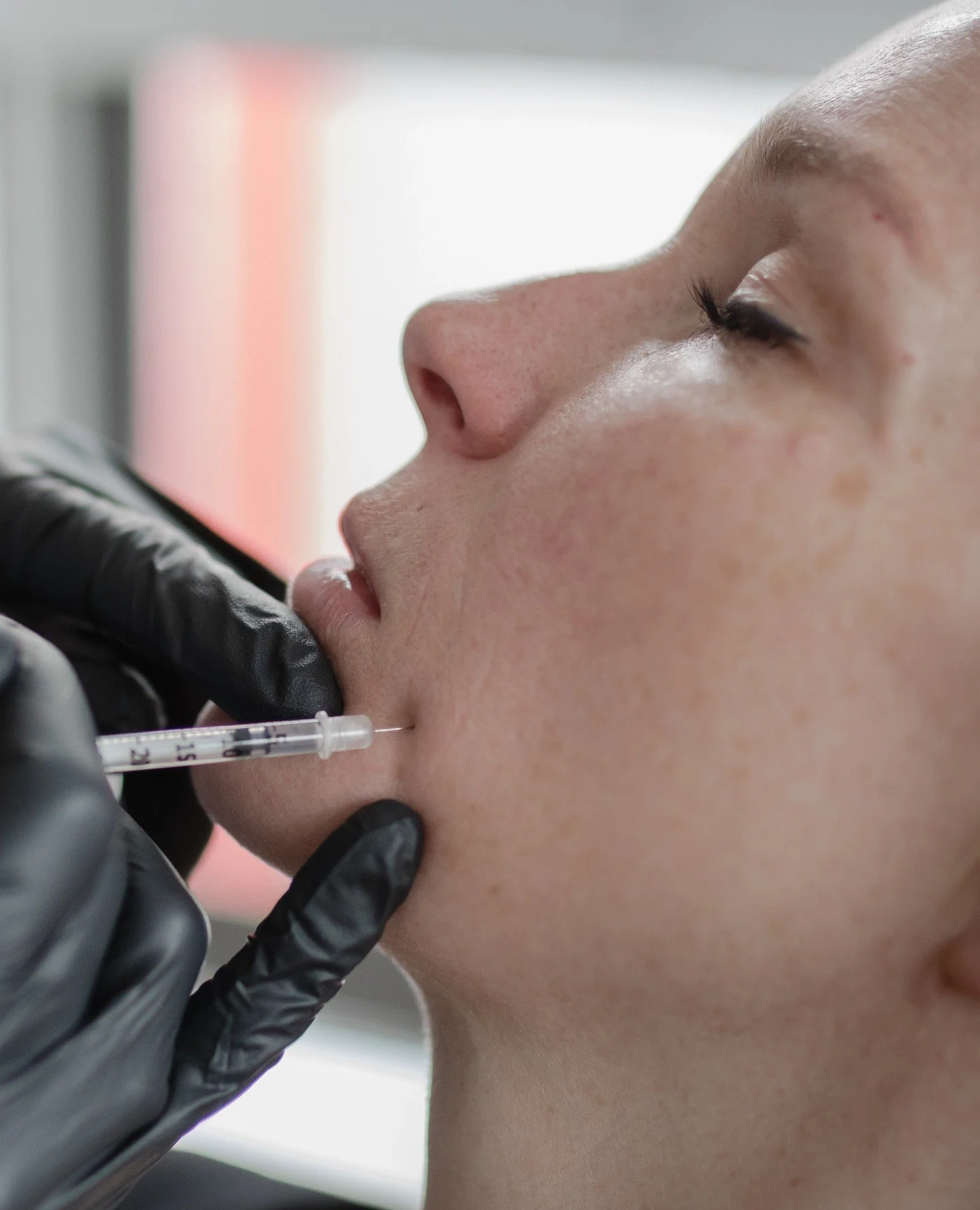 Rosacea? Botox.

Botox offers a unique way to calm redness and inflammation. Injected superficially into the skin, it helps regulate blood vessel dilation and reduce flare-ups. 

Treatments are usually spaced a few months apart, with many patients se