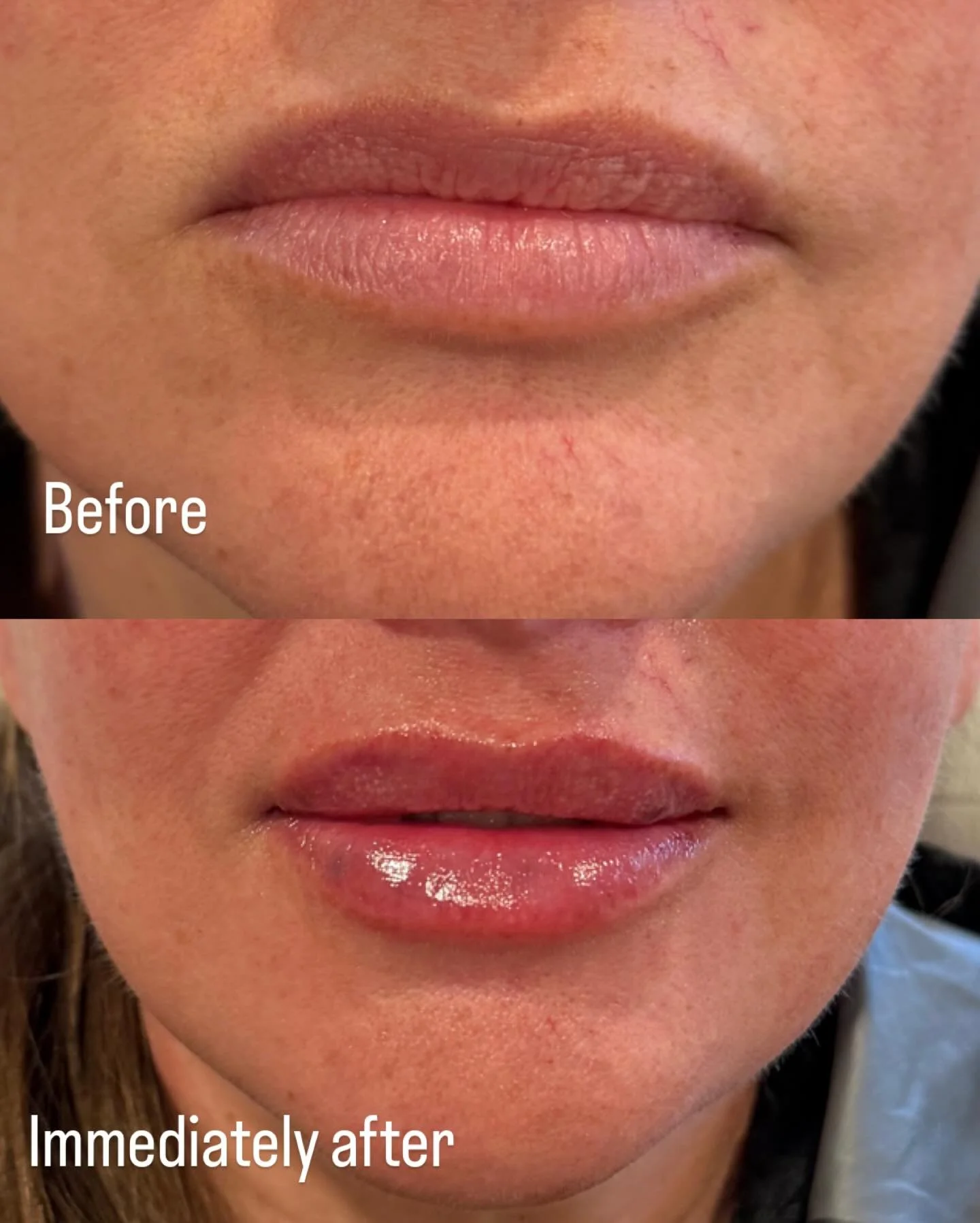Before and after a syringe of juvederm volbella.  Results are immediately after so they will settle over the next month.  Less is more and results should last for years really. 

Link in the bio to schedule. 

Candidates for treatment need to be one 
