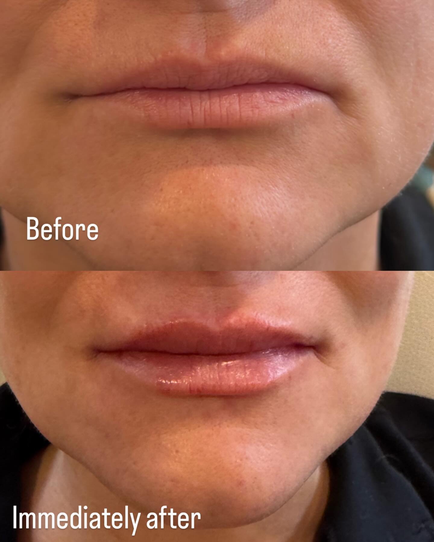 Before and after one syringe of juvederm volbella ❤️