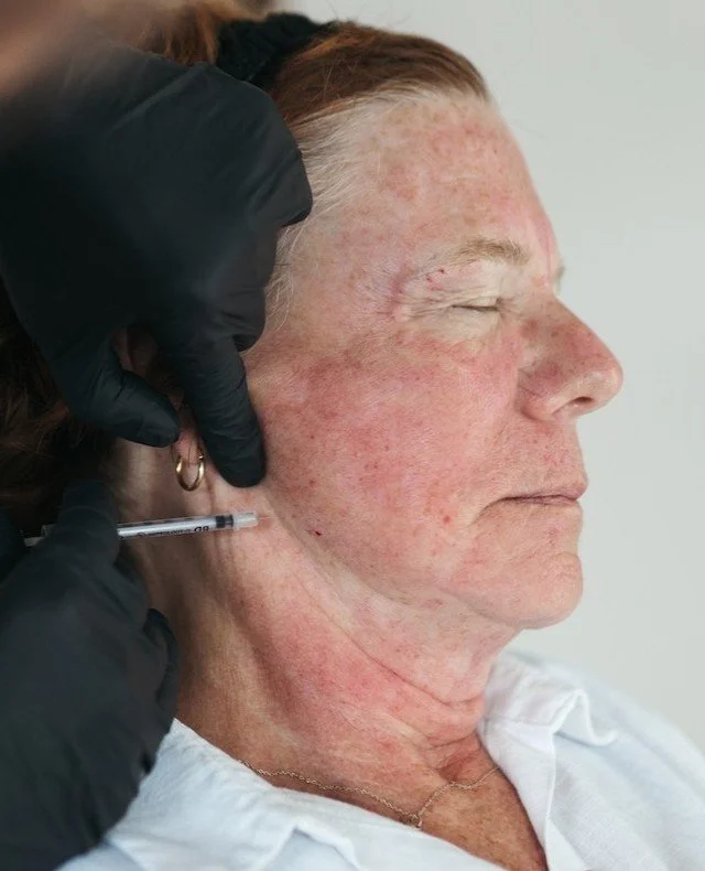 Placement of Botox along the jawline is part of the Nefertiti neck lift. Here we are targeting the platysma muscle to lift, tighten, and define the jawline. 
#AestheticWellness