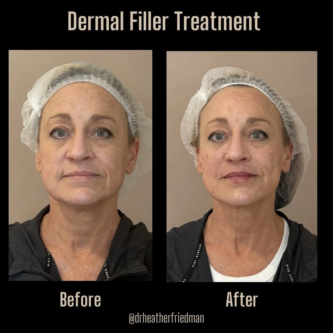 Before and after dermal filler treatment to treat the midface, chin, and around the mouth ❤️