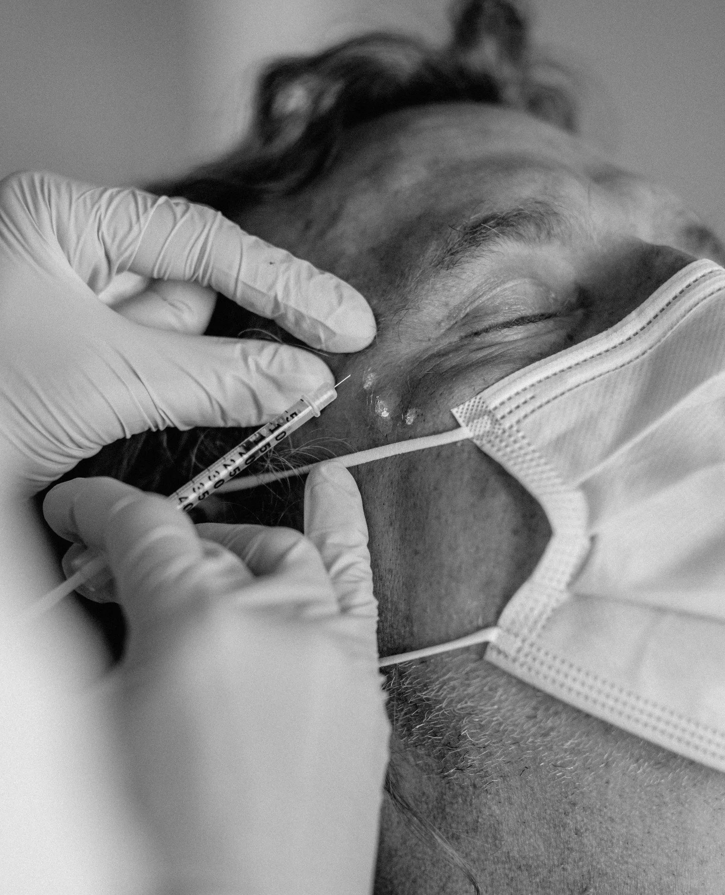 Botox for men is more common than most people think.
The goal is often to soften lines, ease tension, and keep your expression natural and recognizable.

Treatments are tailored to male anatomy, with attention to stronger muscle movement, facial stru
