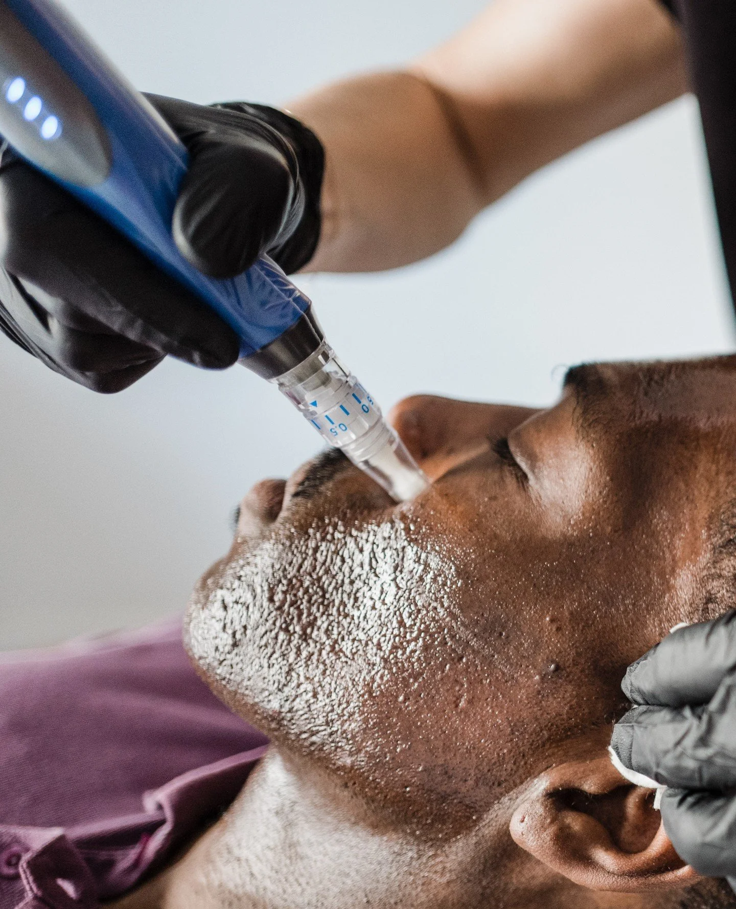 Microneedling stimulates collagen and elastin production, helping to improve texture, soften discoloration, and enhance overall skin quality. A series of treatments is a remarkable way to support skin renewal as we move toward summer. Link in bio to 