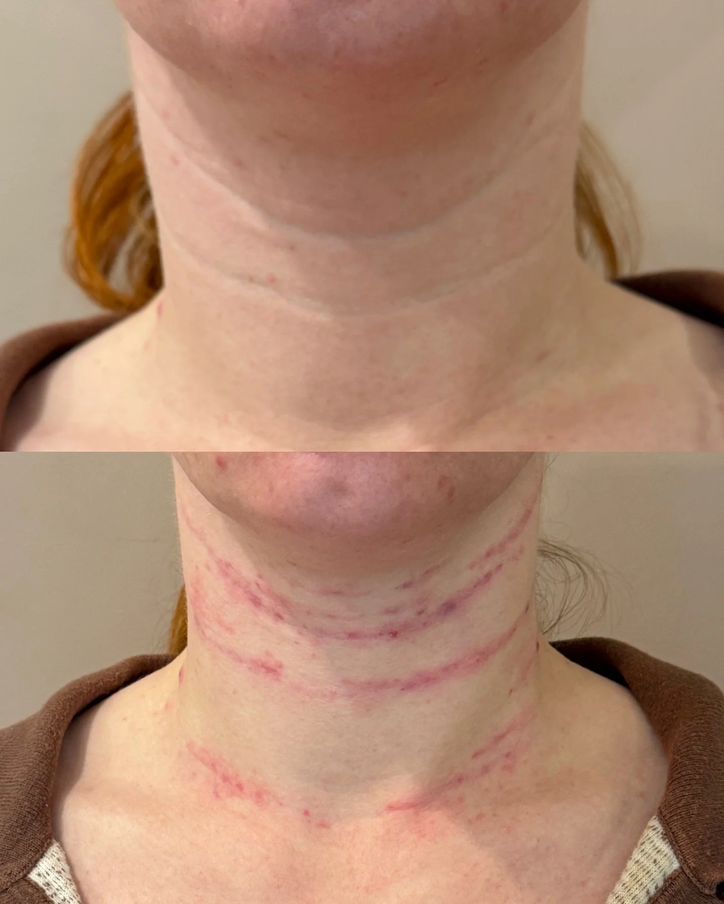 Skinvive hyaluronic acid dermal filler results, two weeks out. The first photo is immediately after treatment. 

We used 2 syringes to improve skin smoothness, texture, and overall quality without adding volume. $600 total.
#DermalFiller #PDX