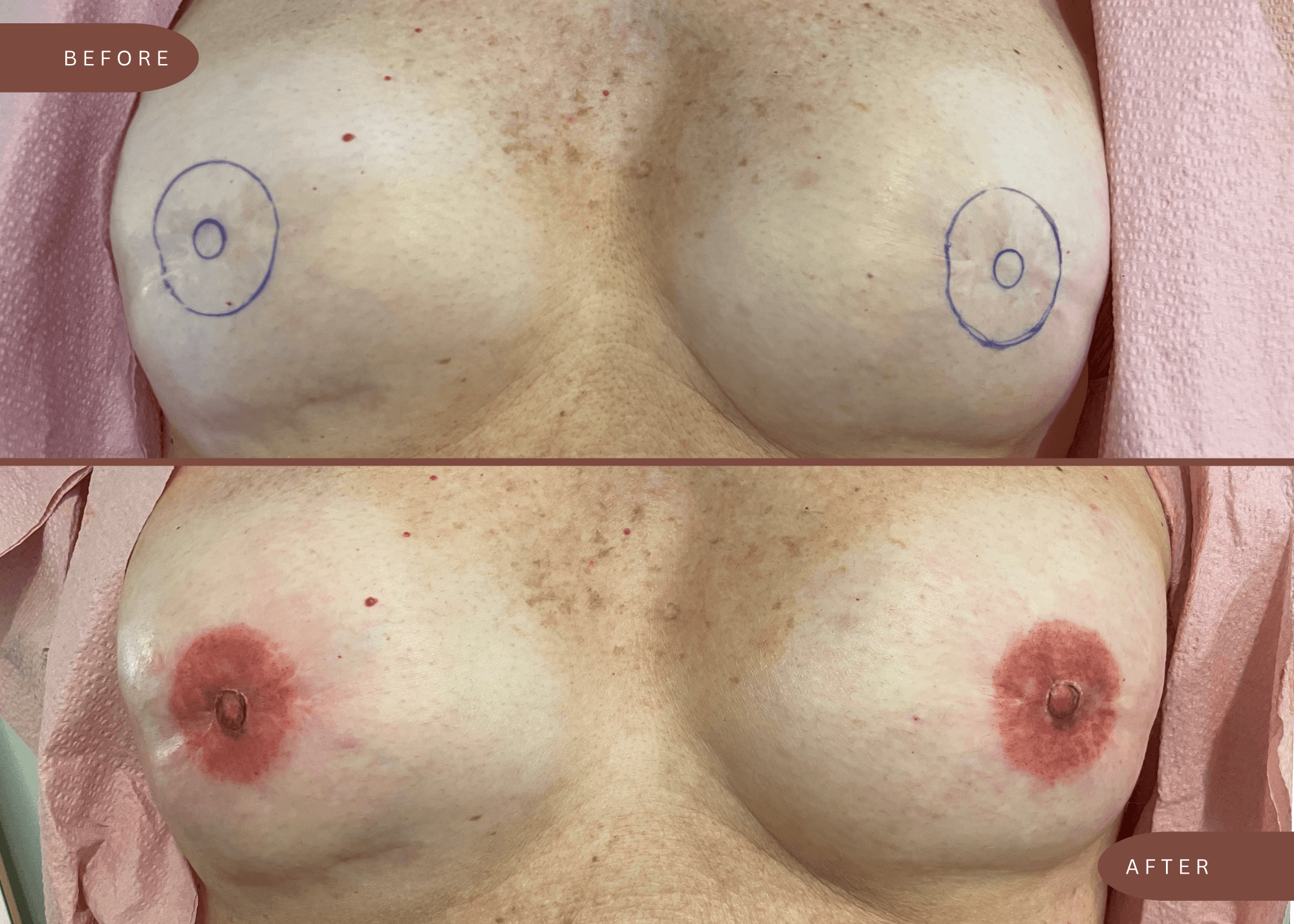 Close-up of a woman’s chest before and after the nipple tattooing procedure, showing marked areas and healed tattooed nipples.