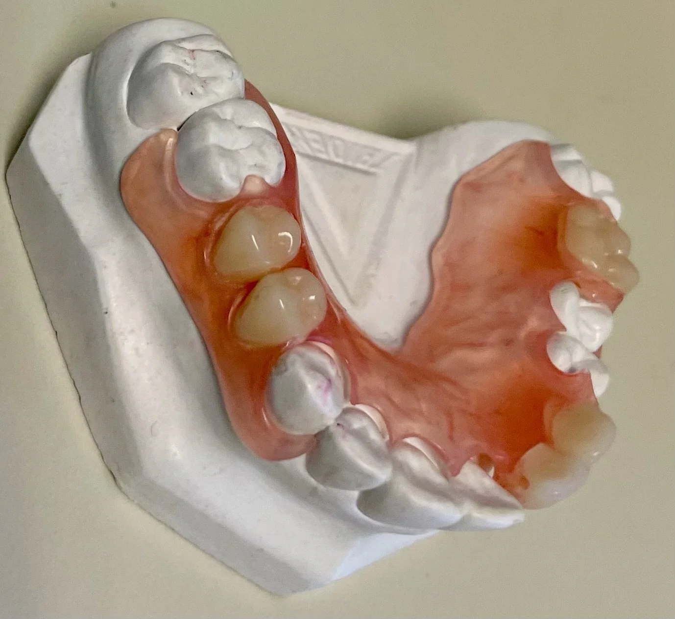 Flexible Esthetic Metal Free Partial Dentures