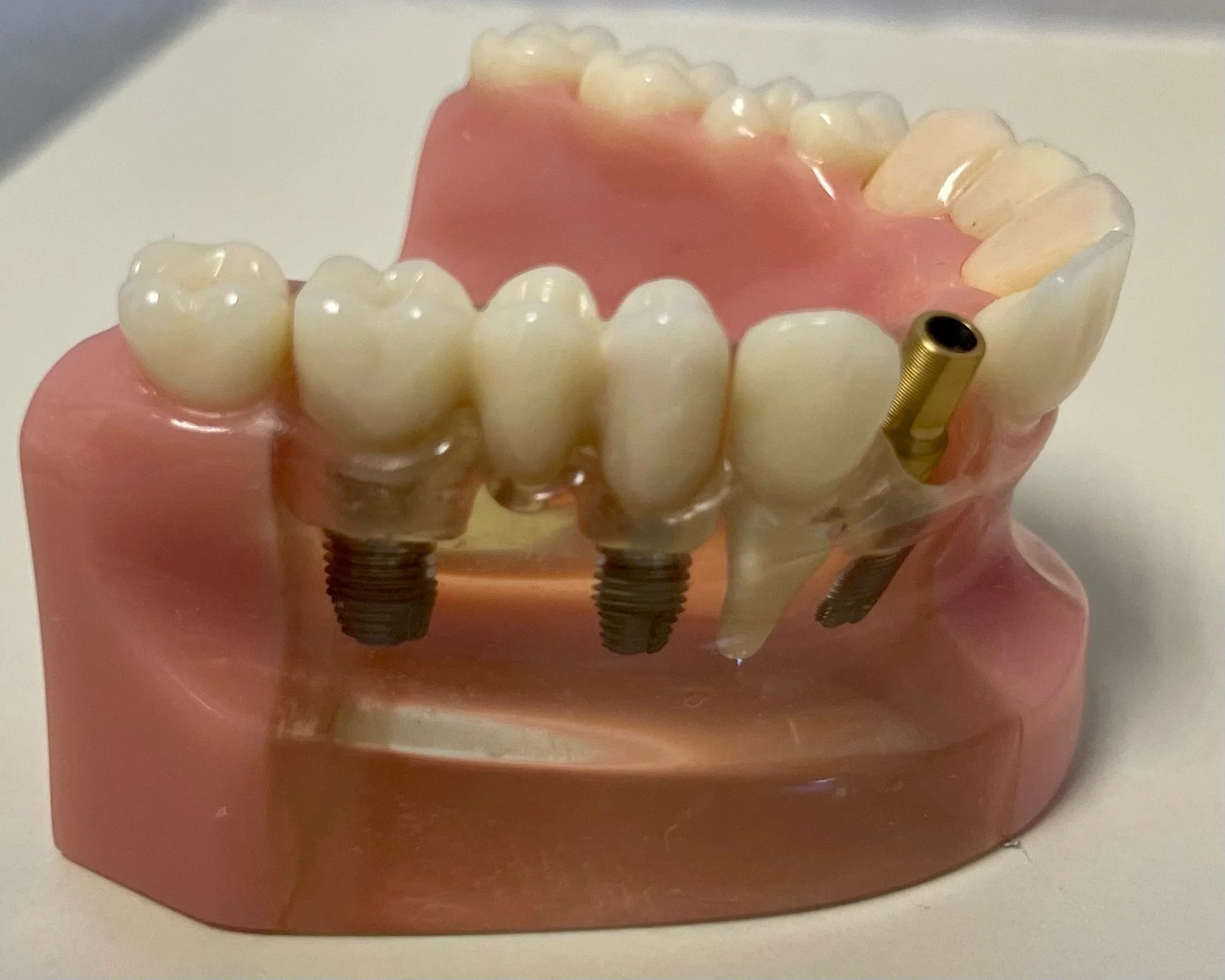 Implant Supported Fixed Bridge