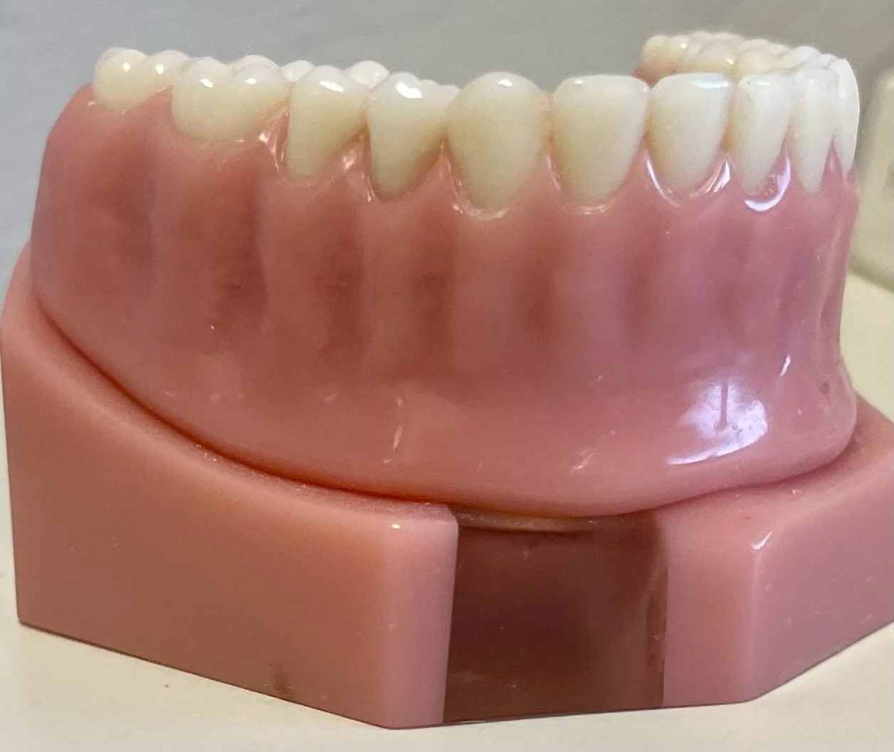 Upper Implant Retained Full Dentures