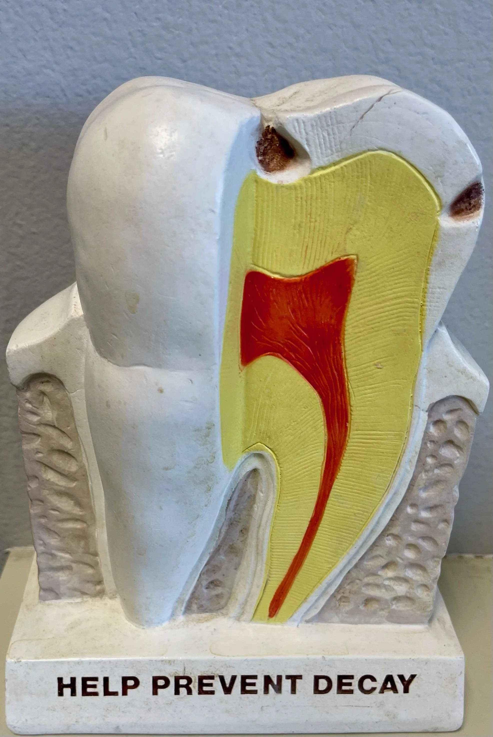 Cavities Restored with Tooth Colored Composite Fillings