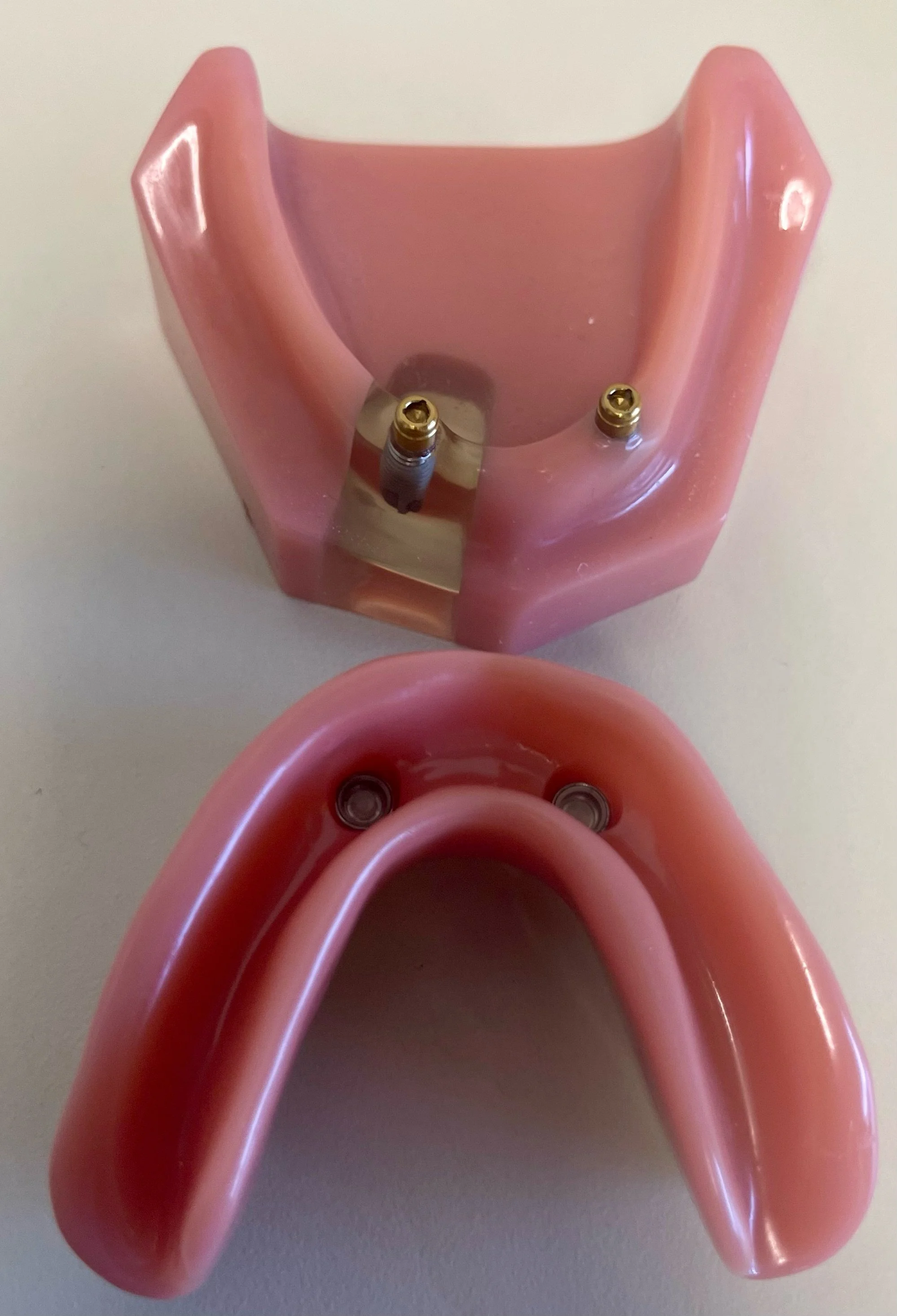Lower Implant Retained "Snap-On" Full Denture