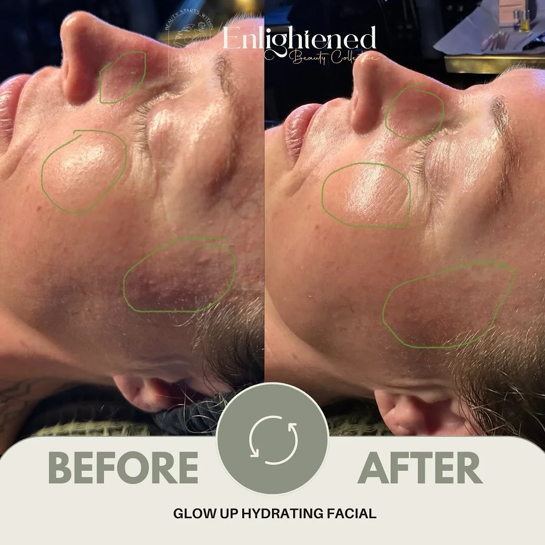 Take a look at the highlighted areas! 💚

Even though her skin was glowing before, look at her texture shift from inflammation to now soothed and balanced in those areas.

Can you see after a customized treatment we soothed her skin and brought her s
