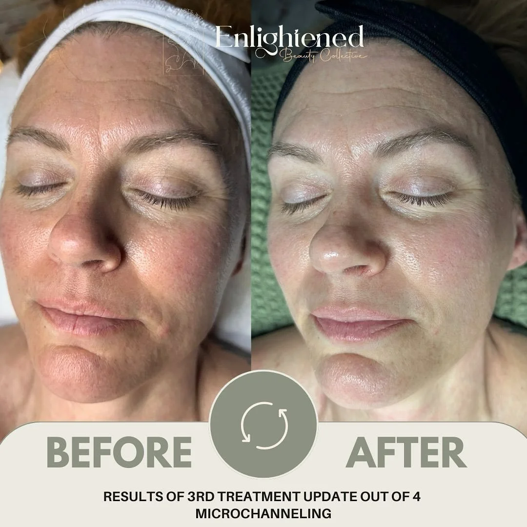 One of the biggest things she started to notice is how much faster her skin is healing since her very first treatment. 

What that says to me is that her skin is beginning to turnover faster, creating the skin cycle to act faster. What does that mean